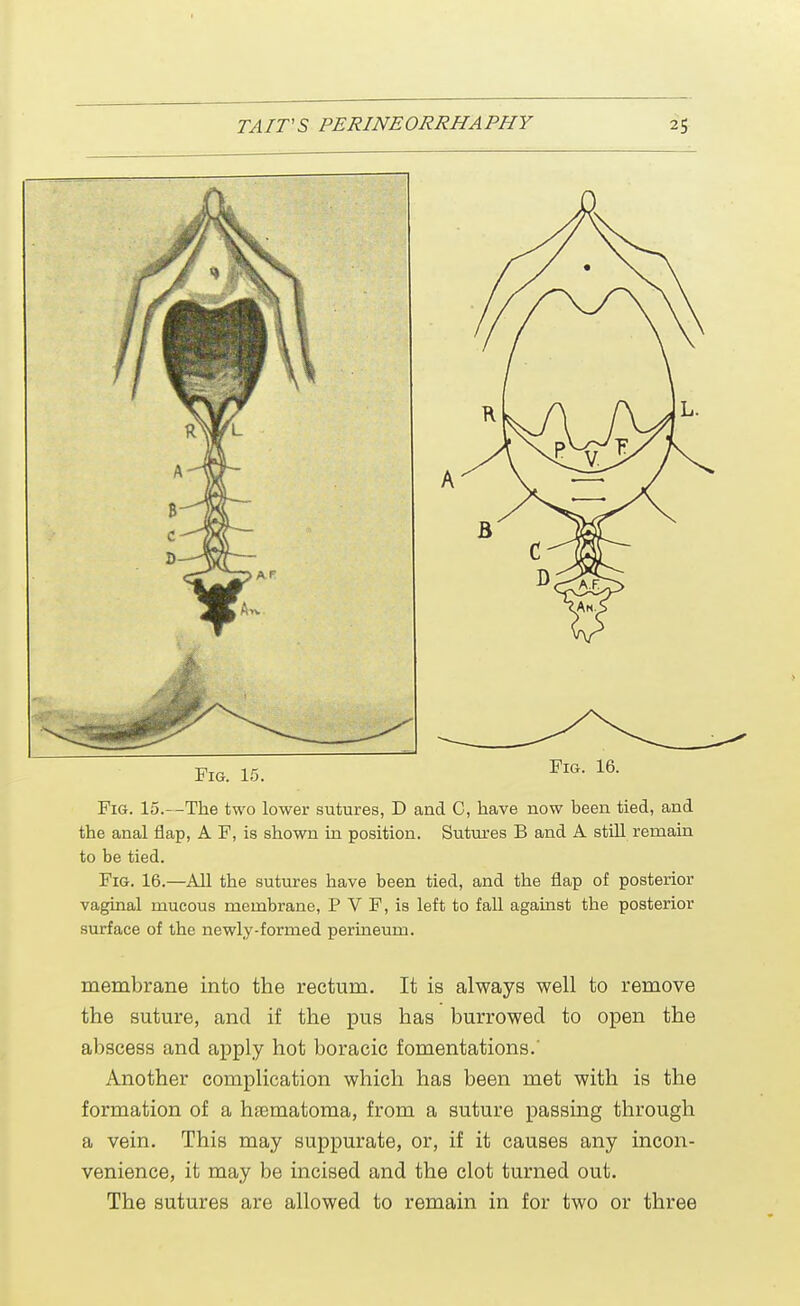 Fig. 15.—The two lower sutures, D and C, have now been tied, and the anal flap, A F, is shown in position. Sutures B and A still remain to be tied. Fig. 16.—All the sutures have been tied, and the flap of posterior vaginal mucous membrane, P V F, is left to fall against the posterior surface of the newly-formed perineum. membrane into the rectum. It is always well to remove the suture, and if the pus has burrowed to open the abscess and apply hot boracic fomentations.' Another complication which has been met with is the formation of a hsematoma, from a suture passing through a vein. This may suppurate, or, if it causes any incon- venience, it may be incised and the clot turned out. The sutures are allowed to remain in for two or three