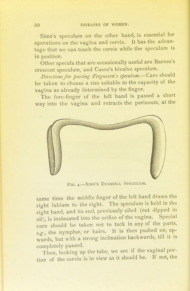 Sims's speculum on the other hand, is essential for operations on the vagina and cervix. It has the advan- tage that we can touch the cervix while the speculum is in position. Other specula that are occasionally useful are Barnes's crescent speculum, and Cusco's bivalve speculum. Directions for passing Fergusson's speculum.—Care should be taken to choose a size suitable to the capacity of the vagina as already determined by the finger. The fore-finger of the left hand is passed a short way into the vagina and retracts the perineum, at the Pig. 4.—Sims's Duckbill Speculum. same time the middle finger of the left hand draws the right labium to the right. The speculum is held in the right hand, and its end, previously oiled (not dipped in oil), is insinuated into the orifice of the vagina. Special care should be taken not to tuck in any of the parts, e.g., the nymphjE, or hairs. It is then pushed on, up- wards, but with a strong inclination backwards, till it is completely passed. Then, looking up the tube, we see if the vaginal por- tion of the cervix is in view as it should be. If not, the