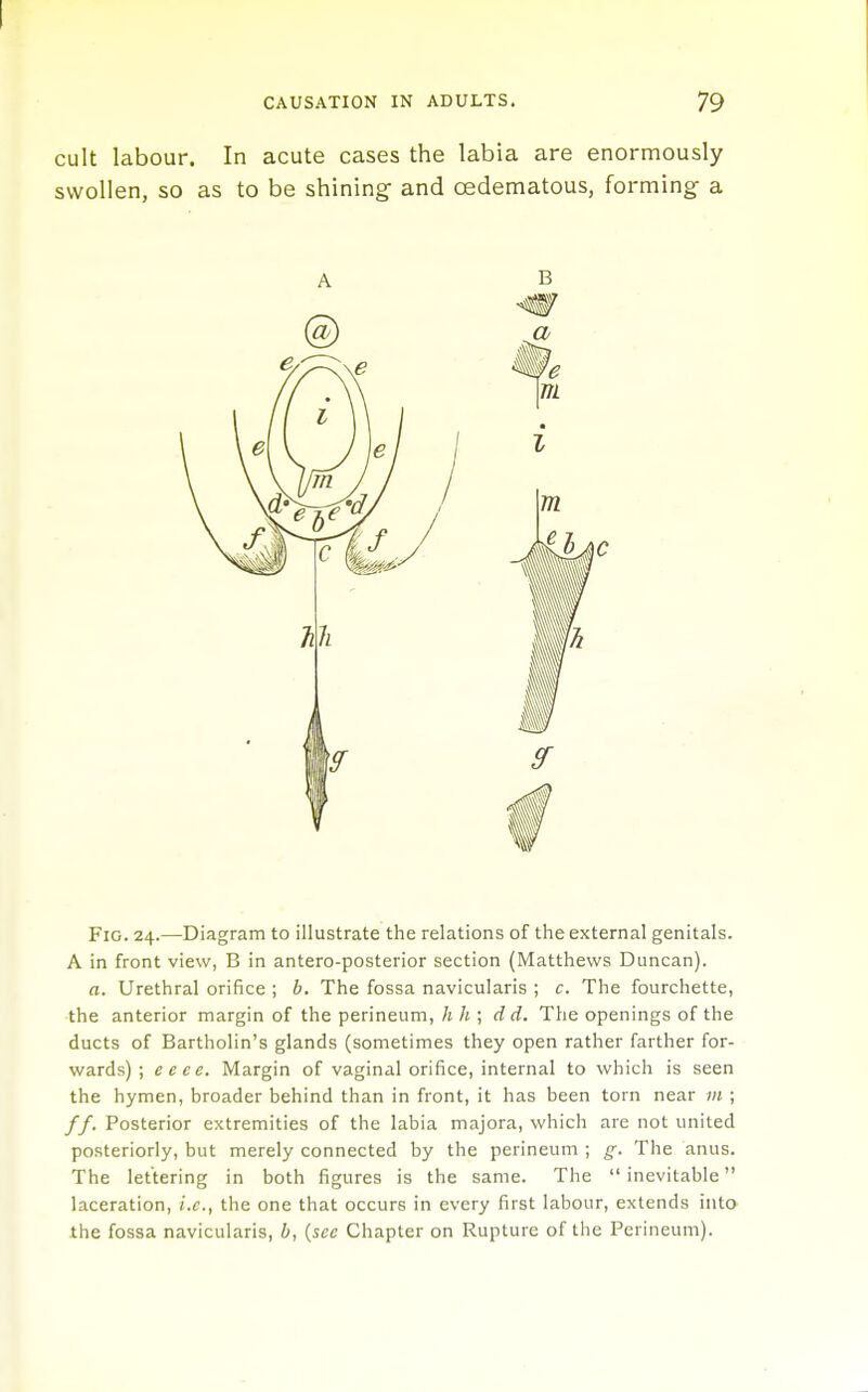 cult labour. In acute cases the labia are enormously swollen, so as to be shining- and oedematous, forming a Fig. 24.—Diagram to illustrate the relations of the external genitals. A in front view, B in antero-posterior section (Matthews Duncan). a. Urethral orifice ; b. The fossa navicularis ; c. The fourchette, the anterior margin of the perineum, h h ; dd. The openings of the ducts of Bartholin's glands (sometimes they open rather farther for- wards) ; ecce. Margin of vaginal orifice, internal to which is seen the hymen, broader behind than in front, it has been torn near m ; /f. Posterior extremities of the labia majora, which are not united posteriorly, but merely connected by the perineum ; g. The anus. The lettering in both figures is the same. The  inevitable laceration, i.e., the one that occurs in every first labour, extends into the fossa navicularis, b, {sec Chapter on Rupture of the Perineum).