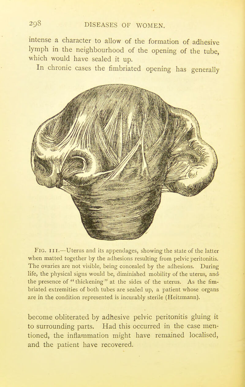 intense a character to allow of the formation of adhesive lymph in the neighbourhood of the opening of the tube, which would have sealed it up. In chronic cases the fimbriated opening has generally Fig. in.—Uterus and its appendages, showing the state of the latter when matted together by the adhesions resulting from pelvic peritonitis. The ovaries are not visible, being concealed by the adhesions. During life, the physical signs would be, diminished mobility of the uterus, and the presence of  thickening at the sides of the uterus. As the fim- briated extremities of both tubes are sealed up, a patient whose organs are in the condition represented is incurably sterile (Heitzmann). become obliterated by adhesive pelvic peritonitis gluing it to surrounding parts. Had this occurred in the case men- tioned, the inflammation might have remained localised, and the patient have recovered.