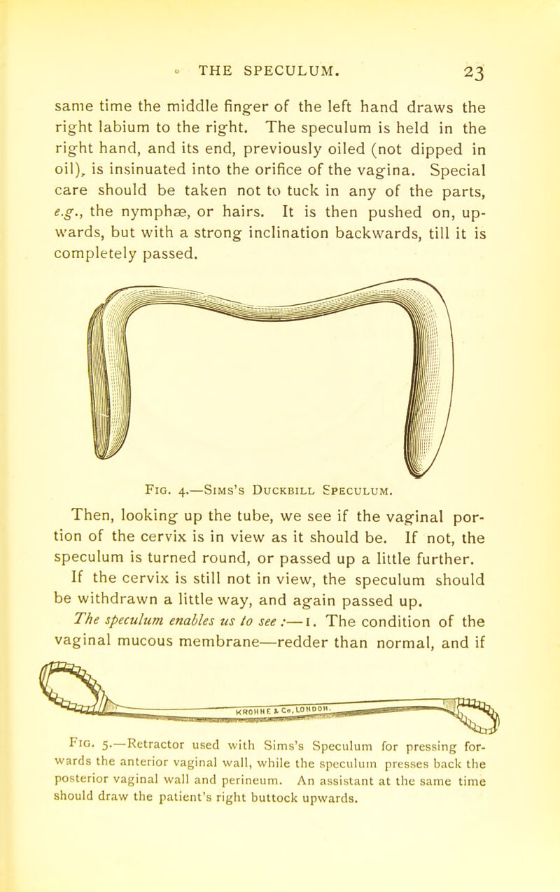 same time the middle finger of the left hand draws the right labium to the right. The speculum is held in the right hand, and its end, previously oiled (not dipped in oil), is insinuated into the orifice of the vagina. Special care should be taken not to tuck in any of the parts, e.g., the nymphae, or hairs. It is then pushed on, up- wards, but with a strong inclination backwards, till it is completely passed. Fig. 4.—SiMs's Duckbill Speculum. Then, looking up the tube, we see if the vaginal por- tion of the cervix is in view as it should be. If not, the speculum is turned round, or passed up a little further. If the cervix is still not in view, the speculum should be withdrawn a little way, and again passed up. T/ie speculum enables us/o see :—i. The condition of the vaginal mucous membrane—redder than normal, and if Fig. 5.—Retractor used with Sims's Speculum for pressing for- wards the anterior vaginal wall, while the speculum presses back the posterior vaginal wall and perineum. An assistant at the same time should draw the patient's right buttock upwards.