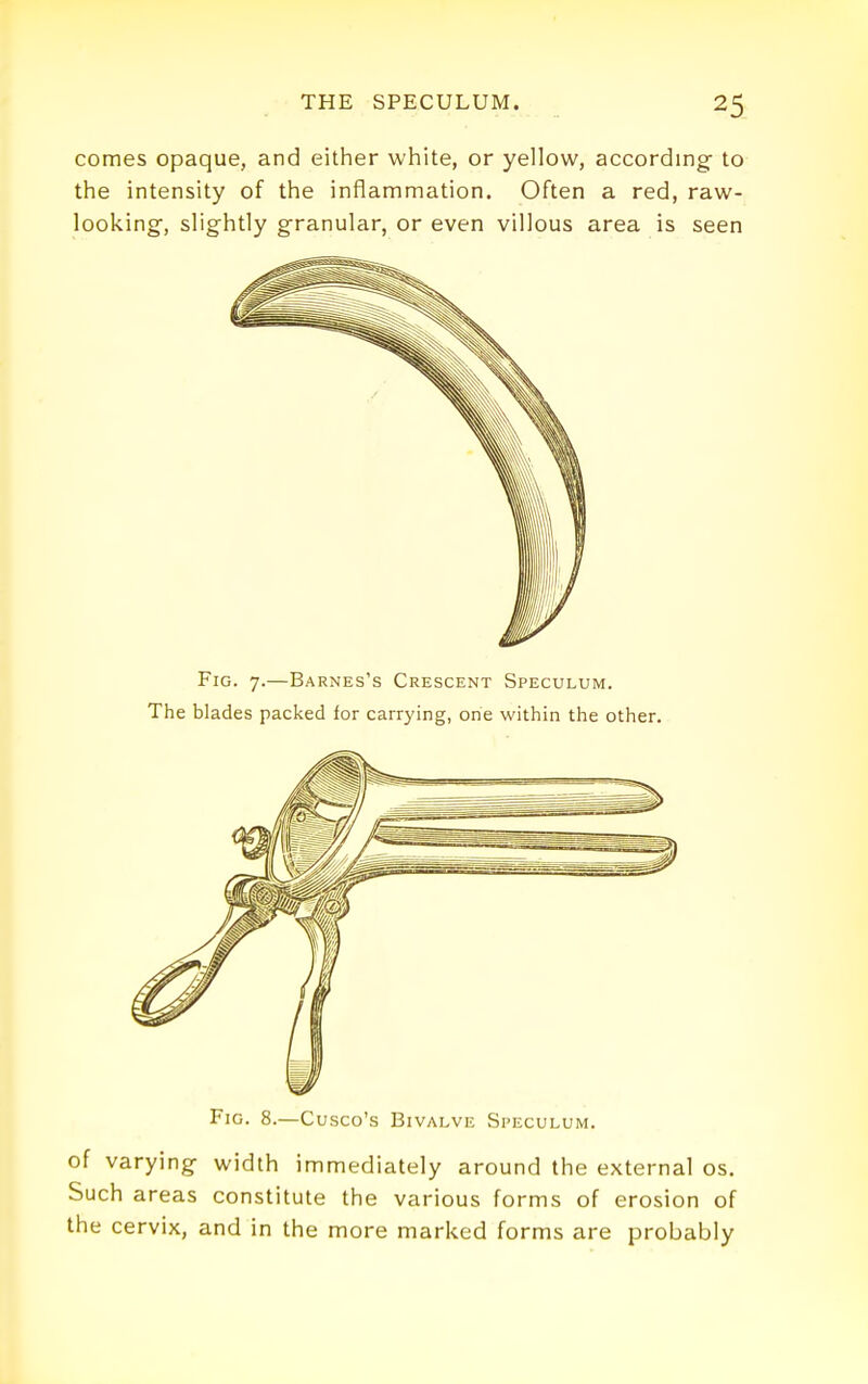 comes opaque, and either white, or yellow, according- to the intensity of the inflammation. Often a red, raw- looking, slightly granular, or even villous area is seen Fig. 7.—Barnes's Crescent Speculum. The blades packed for carrying, one within the other. Fig. 8.—Cusco's Bivalve Speculum. of varying width immediately around the external os. Such areas constitute the various forms of erosion of the cervix, and in the more marked forms are probably