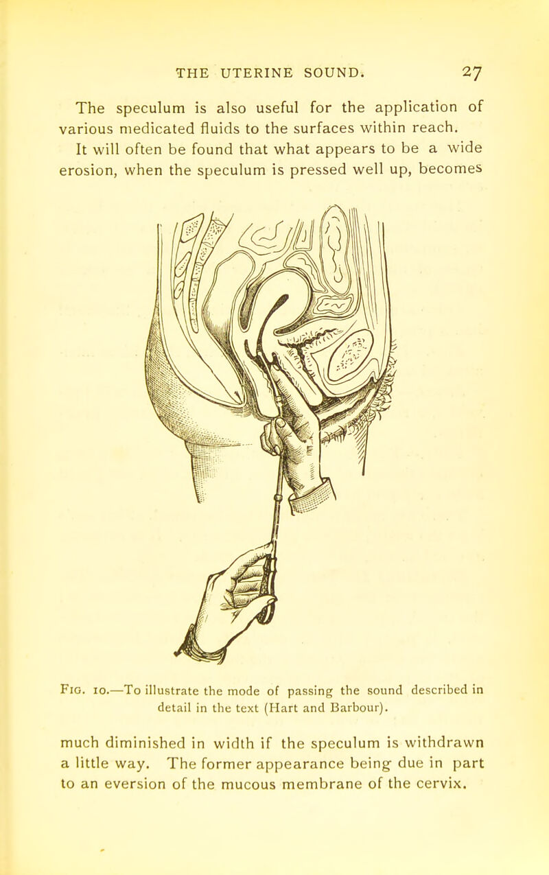 The speculum is also useful for the application of various medicated fluids to the surfaces within reach. It will often be found that what appears to be a wide erosion, when the speculum is pressed well up, becomes Fig. 10.—To illustrate the mode of passing the sound described in detail in the text (Hart and Barbour). much diminished in width if the speculum is withdrawn a little way. The former appearance being due in part to an eversion of the mucous membrane of the cervix.