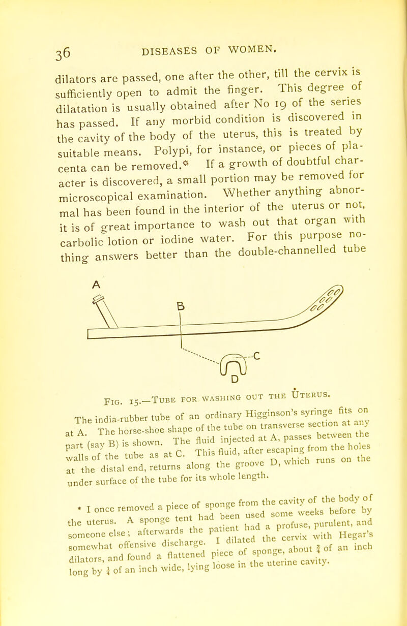 dilators are passed, one after the other, till the cervix ,s sufficiently open to admit the finger. This degree ot dilatation is usually obtained after No 19 of the series has passed. If any morbid condition is discovered in the cavity of the body of the uterus, this is treated by suitable means. Polypi, for instance, or pieces of pla- centa can be removed.'^:* If a growth of doubtful char- acter is discovered, a small portion may be removed for microscopical examination. Whether anything abnor- mal has been found in the interior of the uterus or not^ it is of great importance to wash out that organ ^s'lth carbolic lotion or iodine water. For this P^-'PO^^ °- thino- answers better than the double-channelled tube Fig. 15.-TUBE FOR WASHING OUT THE UtERUS. The india-rubber tube of an ordinary Higginson's syringe fi^ ^ at A. The horse-shoe shape of u>be on transver. e n > cart (say B) is shown. The fluid injected at A, passes betwe ^1 nf the tube as at C. This fluid, after escaping from the holes walls ot the tuoe as di. ,,,liirh runs on the at the distal end, returns along the groove D, which under surface of the tube for its whole length. . , once removed a P^^e of sponge .0. the .vi^^^ the uterus. A sponge tent had be n -^ f ^° .onneoneelse; afterwards the P^/'-^ f^^.h Hegar's ^^Idtra^fllSpirXonge, about .eh fong by i of an inch wide, lying loose in the utenne cavity.