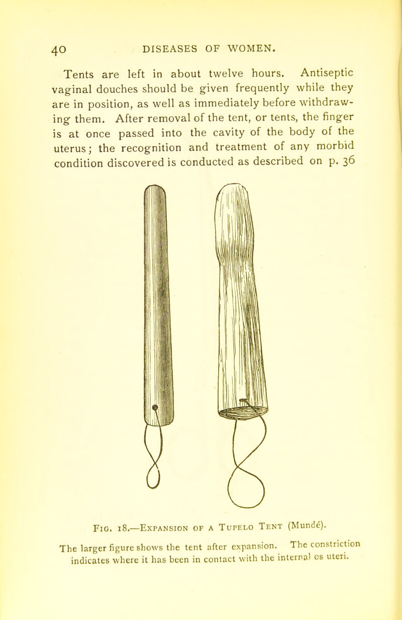 Tents are left in about twelve hours. Antiseptic vaginal douches should be given frequently while they are in position, as well as immediately before withdraw- ing- them. After removal of the tent, or tents, the finger is at once passed into the cavity of the body of the uterus; the recognition and treatment of any morbid condition discovered is conducted as described on p. 36 Fig. 18.—Expansion of a Tupelo Tent (Munde). The larger figure shows the tent after expansion. The const indicates where it has been in contact with the interna) os u