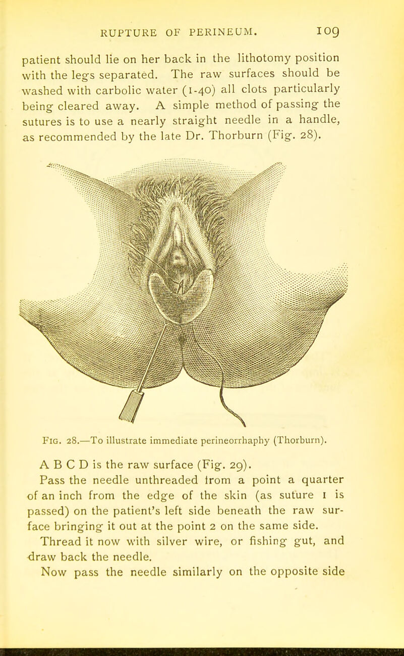 patient should lie on her back in the lithotomy position with the leg-s separated. The raw surfaces should be washed with carbolic water (1-40) all clots particularly being cleared away. A simple method of passing- the sutures is to use a nearly straight needle in a handle, as recommended by the late Dr. Thorburn (Fig. 28). Fig. 28.—To illustrate immediate perineorrhaphy (Thorburn). A B C D is the raw surface (Fig. 29). Pass the needle unthreaded Irom a point a quarter of an inch from the edge of the skin (as suture i is passed) on the patient's left side beneath the raw sur- face bringing it out at the point 2 on the same side. Thread it now with silver wire, or fishing gut, and draw back the needle. Now pass the needle similarly on the opposite side