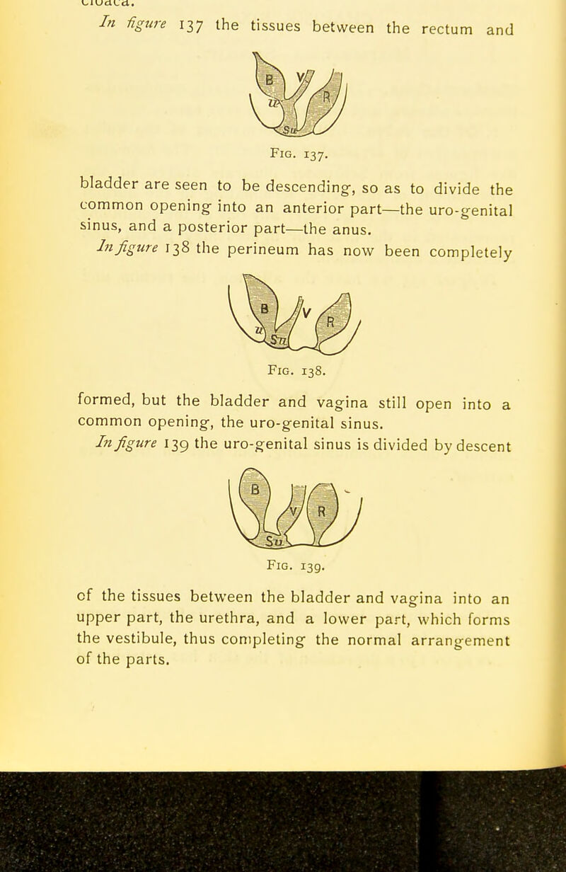 Fig. 137. bladder are seen to be descending-, so as to divide the common opening into an anterior part—the uro-genital sinus, and a posterior part—the anus. In figure 138 the perineum has now been completely Fig. 138. formed, but the bladder and vagina still open into a common opening, the uro-genital sinus. In figure 139 the uro-genital sinus is divided by descent Fig. 139. of the tissues between the bladder and vagina into an upper part, the urethra, and a lower part, which forms the vestibule, thus completing the normal arrangement of the parts.