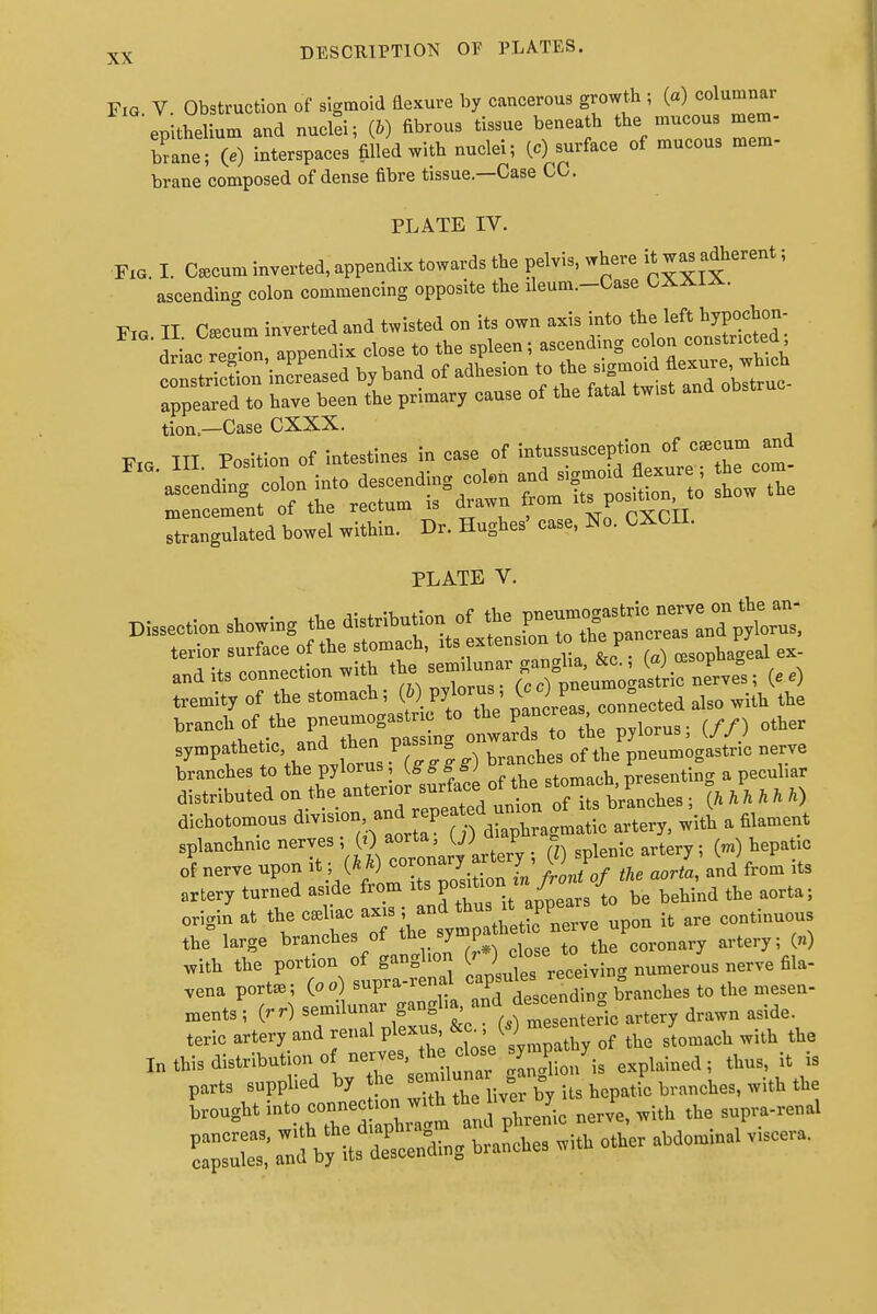 Fig V. Obstruction of sigmoid flexure by cancerous growth ; (a) columnar epithelium and nuclei; (6) fibrous tissue beneath the mucous mem- brane; 00 interspaces filled with nuclei; (c) surface of mucous mem- brane composed of dense fibre tissue.—Case CC. PLATE IV. Fig. I. C^cum inverted, appendix towards the pelvis, where it was adherent; ascending colon commencing opposite the ileum.-Case CXX1A. tion.—Case CXXX. Fig. in. Position of intestines in case of ^T^^^^. strangulated bowel within. Dr. Hughes' case, No. CXCII. PLATE V. Dissection showing the distribution of the P^^^^ terior surface of the stomach, ^.^^^^J^L^ ex- acts connection with ^.^(^8X;^^' c-o tremity of the stomach; (S) pylorus (^^^ als0 ^ the sympathetic and hen- V™ * of tbe neum0gastric nerve branches to the pylorus, (tfff g) ™ Resenting a peculiar distributed on the antenor surface of the stomach, p 0 i aichotomous ^tf^g^tt* a filament splanchnic nerves 0 * > J g> lenic artery. (m) hepatic of nerve upon it; {hk) coronary axwry, d from ;ts artery turned aside from its ^taon be Dehind the aorta; origlnyat toc^-^^^^ it are continuous the large branches of the symp artery. (n) with the portion of ganglion (, Jclose> ^ fik_ vena port.; (oo) supra-renal caj^£j^ * tQ ^ mesen. ments ; (rf) f^J^ artery drawn aside teric artery and renal plexus, &c W. wHh ^ In this distribution ofnerves th close J 7. ^ ^ . h parts supplied by the se = £ Us h tic branches, with the brought ^t^^^ — ^ the supra-renal anfbyL descending branches »Hh other abdom.nal viscera.