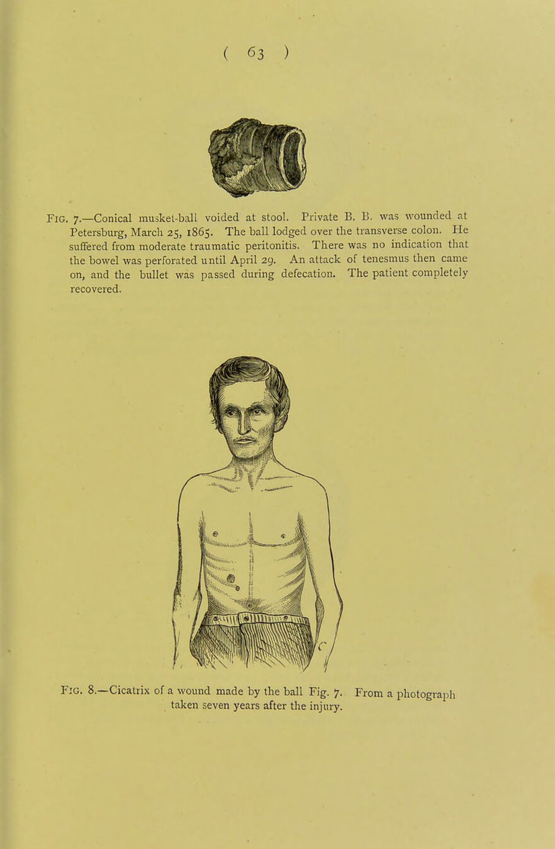 Fig. 7.—Conical musket-ball voided at stool. Private B. B. was wounded at Petersburg, Marcli 25, 1865. The ball lodged over the transverse colon. He suffered from moderate traumatic peritonitis. There was no indication that the bowel was perforated until April 29. An attack of tenesmus then came on, and the bullet was passed during defecation. The patient completely recovered. Fig. 8.—Cicatrix of a wound made by the ball Fig. 7. From a photograph taken seven years after the injury.