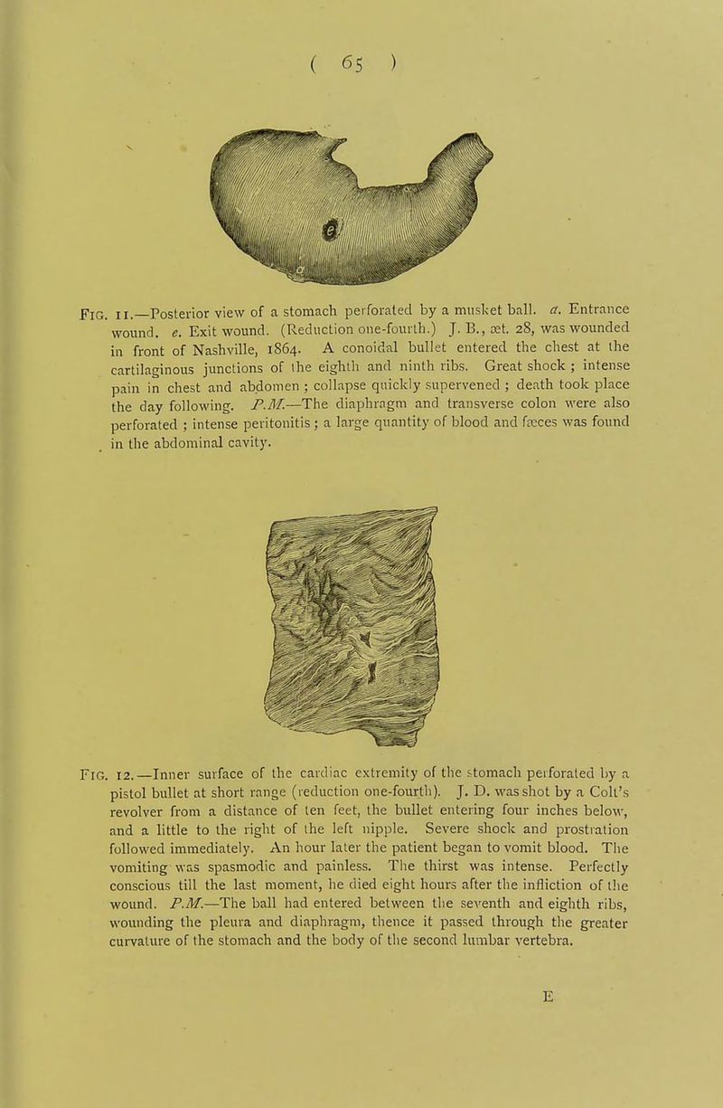 flG. II. Posterior view of a stomach perforated by a musket ball. a. Entrance wound, e. Exit wound. (Reduction one-fourth.) J. B., oet. 28, was wounded in front of Nashville, 1864. A conoidal bullet entered the chest at the cartilaginous junctions of ihe eighth and ninth ribs. Great shock ; intense pain in chest and abdomen ; collapse quickly supervened ; death took place the day following. P.M.—The diaphragm and transverse colon were also perforated ; intense peritonitis ; a large quantity of blood and frcces was found in the abdominal cavity. Fig. 12.—Inner surface of the cardiac extremity of the stomach perforated by a pistol bullet at short range (reduction one-fourth). J. D. was shot by a Colt's revolver from a distance of ten feet, the bullet entering four inches below, and a little to the right of the left nipple. Severe shock and prostration followed immediately. An hour later the patient began to vomit blood. The vomiting was spasmodic and painless. The thirst was intense. Perfectly conscious till the last moment, lie died eight hours after the infliction of llie wound. P.M.—The ball had entered between the seventh and eighth ribs, wounding the pleura and diaphragm, thence it passed through the greater curvature of the stomach and the body of the second lumbar vertebra. E