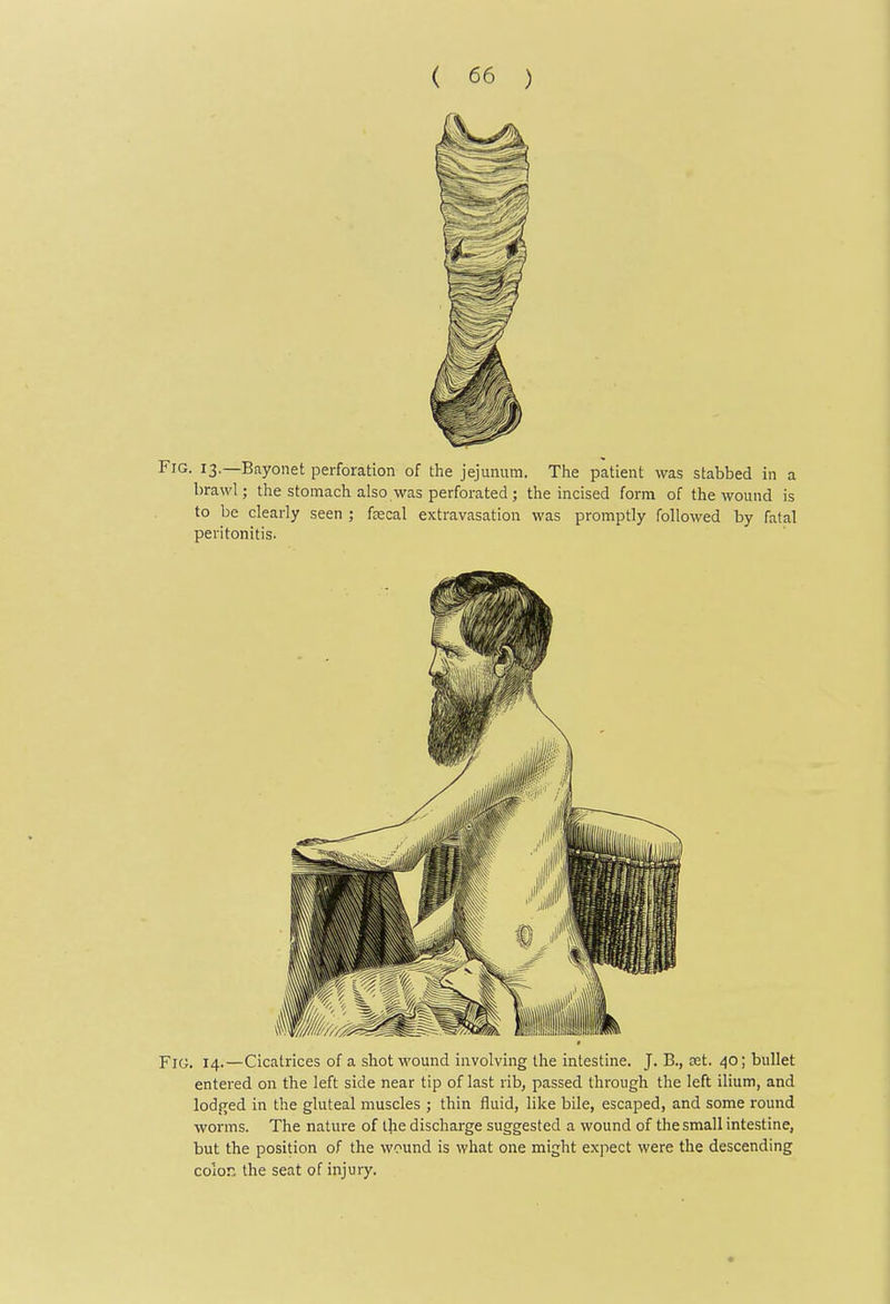 Fig. 13.—Bayonet perforation of the jejunum. The patient was stabbed in a brawl; the stomach also was perforated ; the incised form of the wound is to be clearly seen ; fsecal extravasation was promptly followed by fatal peritonitis. Fig. 14.—Cicatrices of a shot wound involving the intestine. J. B., cet. 40; bullet entered on the left side near tip of last rib, passed through the left ilium, and lodged in the gluteal muscles ; thin fluid, like bile, escaped, and some round worms. The nature of the discharge suggested a wound of the small intestine, but the position of the wound is what one might expect were the descending colon the seat of injury.