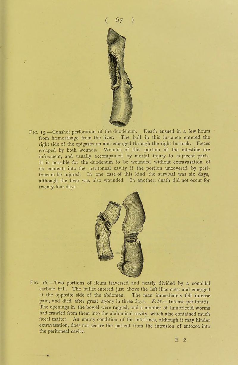 Fig. 15.—Gunshot perforation of the duodenum. Death ensued in a few hours from hcemorrhage from the liver. The ball in this instance entered the right side of the epigastrium and emerged through the right buttock. Fasces escaped by both wounds. Wounds of this portion of the intestine are infrequent, and usually accompanied by mortal injury to adjacent parts. It is possible for the duodenum to be wounded without extravasation of its contents into the peritoneal cavity if the portion uncovered by peri- toneum be injured. In one case of this kind the survival was six days, although the liver was also wounded. In another, death did not occur for twenty-four days. Fig. 16.—Two portions of ileum traversed and nearly divided by a conoidal carbine ball. The bullet entered just above the left iliac crest and emerged at the opposite side of the abdomen. The man immediately felt intense pain, and died after great agony in three days. P.M.—Intense peritonitis. The openings in the bowel were ragged, and a number of lumbricoid worms had crawled from them into the abdominal cavity, which also contained much ftecal matter. An empty condition of the intestines, although it may hinder extravasation, does not secure the patient from the intrusion of entozoa into the peritoneal cavity.