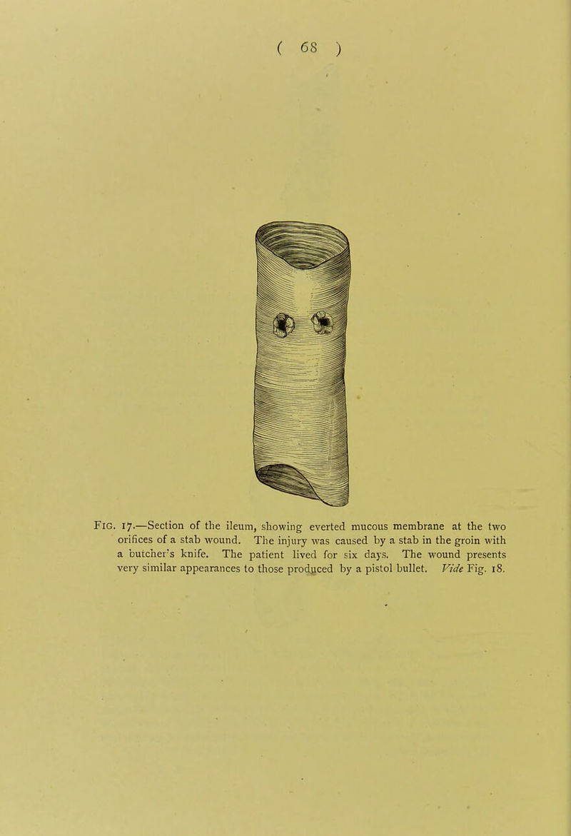 Fig. 17.—Section of the ileum, showing everted mucous membrane at the two orifices of a stab Avound. The injury was caused by a stab in the groin with a butcher's knife. The patient lived for six days. The wound presents very similar appearances to those produced by a pistol bullet. Vide Fig. 18.