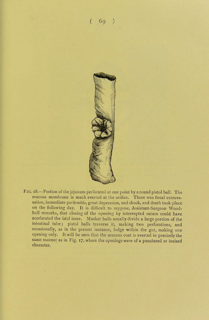 Fig. i8.—Portion of ihe jejunum peiforated at one point by a round pistol ball. The mucous membrane is much everted at the orifice. There was fsecal extrava- sation, immediate peritonitis, great depression, and shock, and death took place on the following day. It is difficult to suppose, Assistant-Surgeon Wood- hall remarks, that closing of the opening by interrupted suture could have accelerated the fatal issue. Musket balls usually divide a large portion of the intestinal tube; pistol balls traverse it, making two perforations, and occasionally, as in the present instance, lodge within the gut, making one opening only. It will be seen that the mucous coat is everted in precisely the same manner as in Fig. 17, where the openings were of a punctured or incised character.
