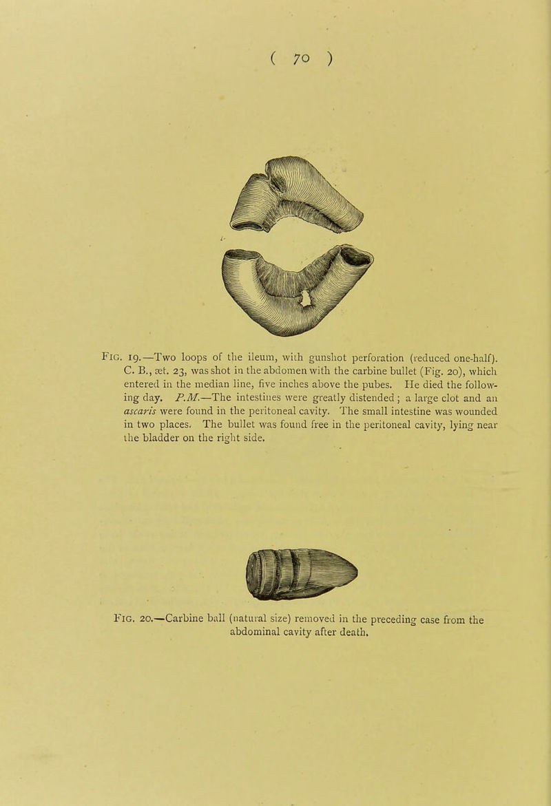 Fig. 19.—Two loops of the ileum, wiih gunshot perforation (reduced one-half). C. B., Eet. 23, was shot in the abdomen with the carbine bullet (Fig. 20), whicli entered in the median line, five inches above the pubes. He died the follow- ing day. P.M.—The intestines were greatly distended ; a large clot and an ascaris were found in the peritoneal cavity. The small intestine was wounded in two places. The bullet was found free in the peritoneal cavity, lying near the bladder on the right side. Fig. 20.—Carbine ball (natural size) removed in the preceding case from the abdominal cavity after death.