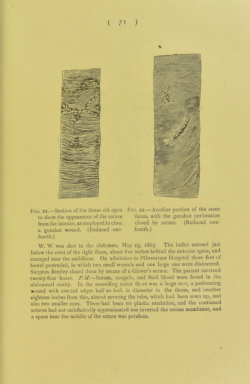 Fig. 21.—Section of the ileum slit open Fig. 22.—Another portion of the same to show the appearance of the suture ileum, with the gunshot perforation from the interior, as employed to close closed by suture. (Reduced one- a gunshot wound. (Reduced one- fourth.) fourth.) W. W. was shot in the abdomen, May 23, 1865. The bullet entered just below the crest of the right ilium, about five inches behind the anterior spine, and emerged near the umbilicus. On admission to I'Ouverture Hospital three feet of bowel protruded, in which two small wounds and one large one were discovered. Surgeon Bentley closed them by means of a Glover's suture. The patient survived twenty-four hours. /'./I/.—Serum, coagula, and fluid blood were found in the abdominal cavity. In the ascending colon th.-re was a large rent, a perforating wound with everted edges half an inch in diameter in the ileum, and another eighteen inches from this, almost severing the tube, which had been sewn up, and also two smaller ones. There had been no plastic exudation, and the continued sutures had not satisfactorily approximated nor inverted the serous membrane, and a space near the middle of the suture was patulous.
