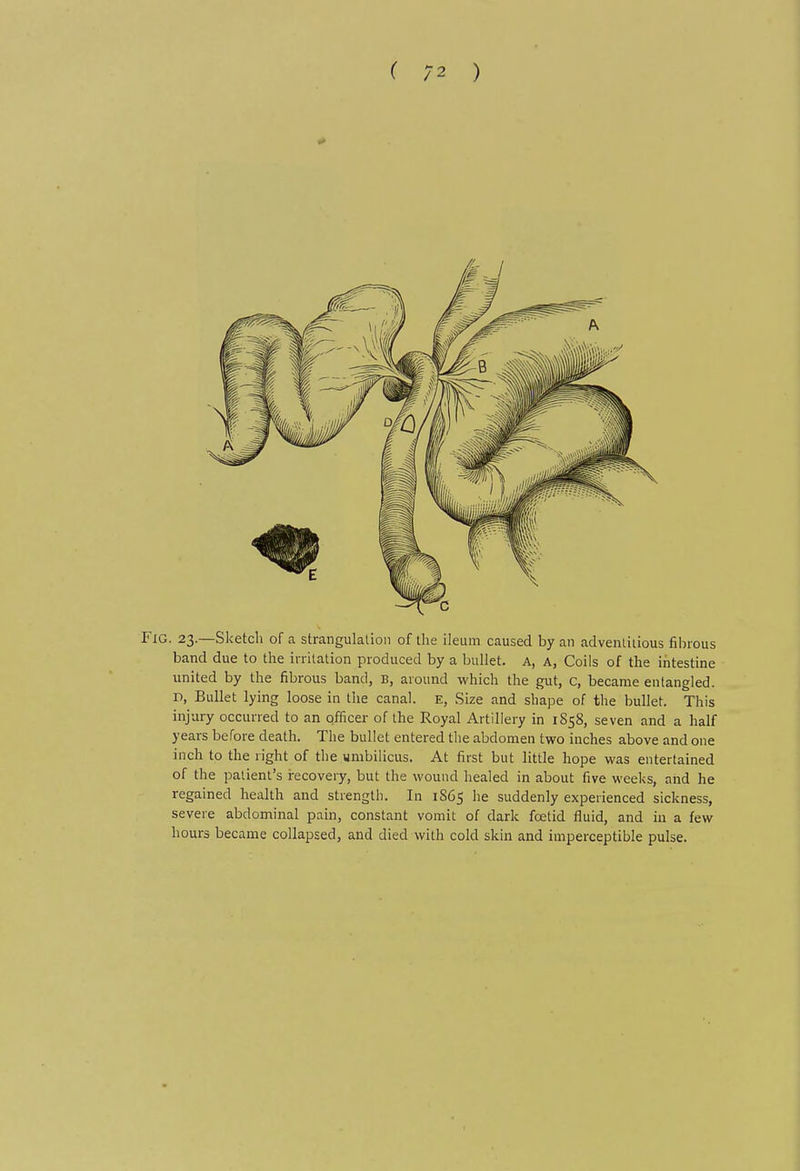 ( /2 ) Fig. 23.—Sketch of a strangulation of the ileum caused by an adventiiious filHOus band due to the irritation produced by a bullet. A, A, Coils of the intestine united by the fibrous band, B, around which the gut, c, became entangled. D, Bullet lying loose in the canal. E, Size and shape of the bullet. This injury occurred to an officer of the Royal Artillery in 1858, seven and a half years before death. The bullet entered the abdomen two inches above and one inch to the right of the umbilicus. At first but little hope was entertained of the patient's irecovery, but the wound healed in about five weeks, and he regained health and strength. In 1865 he suddenly experienced sickness, severe abdominal pain, constant vomit of dark foetid fluid, and in a few hours became collapsed, and died with cold skin and imperceptible pulse.