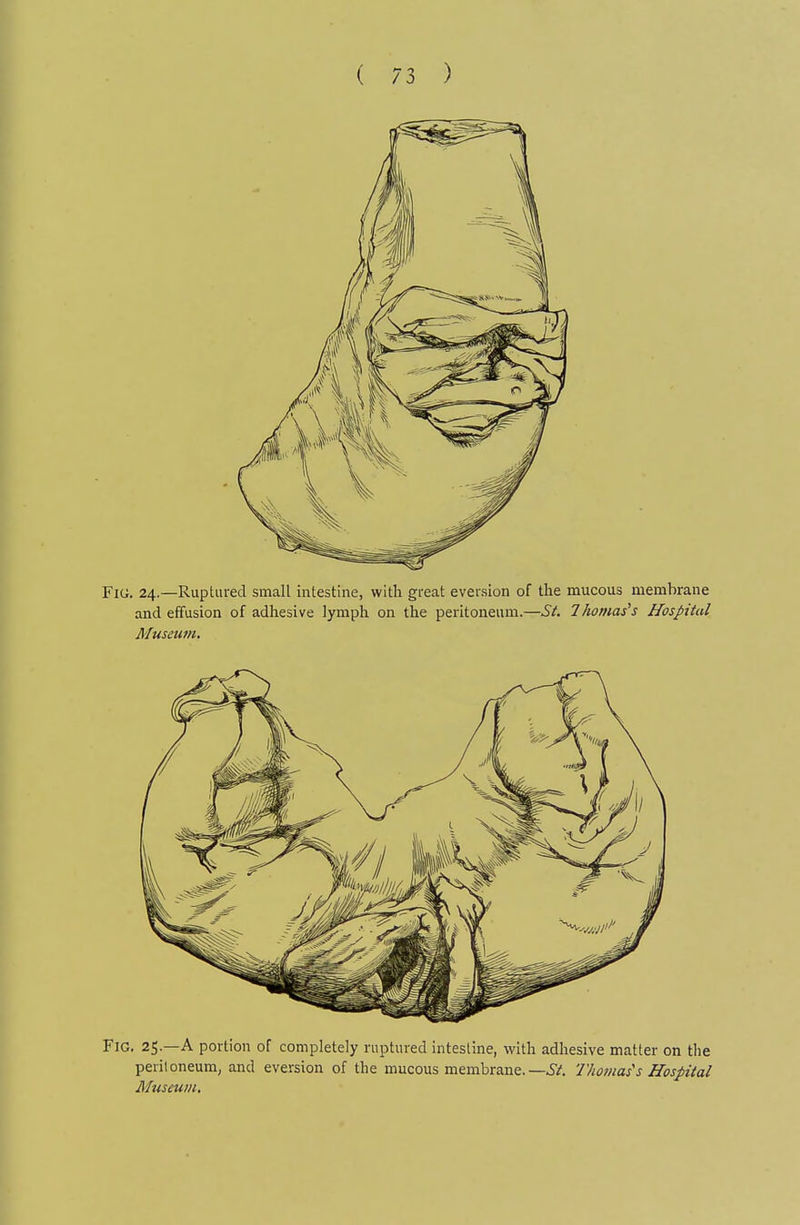 Fici. 24.—Ruptured small intestine, with great eversion of the mucous membrane and effusion of adhesive lymph on the peritoneum.—St. Thomases Hospital Museum. Fig. 25—a portion of completely ruptured intestine, with adhesive matter on tlie peril oneum^ and eversion of the mucous membrane.—i/. Thomas's Hospital Museum.