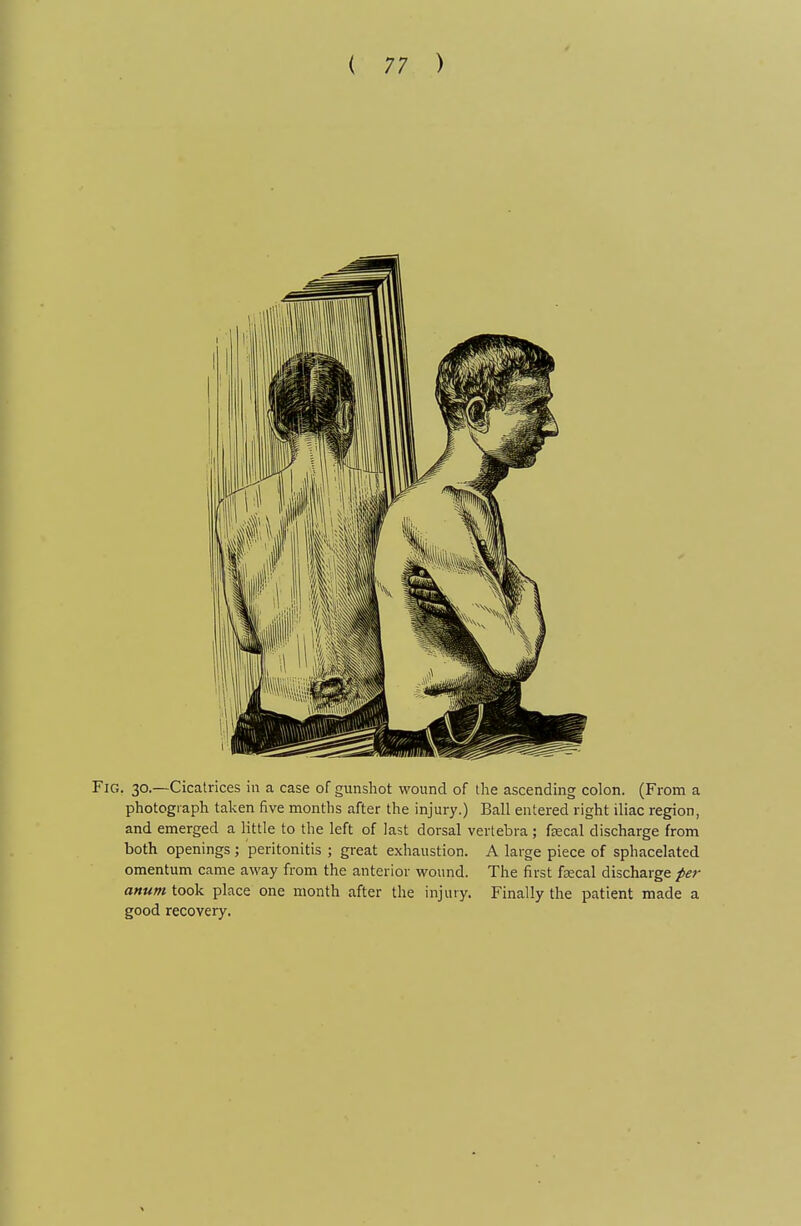 Fig. 30.—Cicatrices in a case of gunshot wound of the ascending colon. (From a photograph taken five months after the injury.) Ball entered right iliac region, and emerged a little to the left of last dorsal vertebra; ftecal discharge from both openings; peritonitis ; great exhaustion. A large piece of sphacelated omentum came away from the anterior wound. The first fxcal discharge per anum took place one month after the injury. Finally the patient made a good recovery.