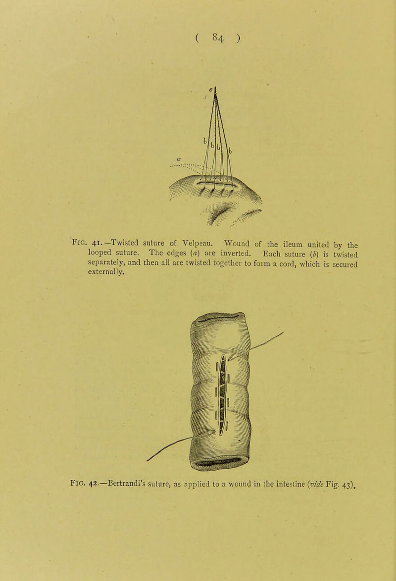 Fig, 41.—Twisted suture of Velpeau. Wound of ihe ileum united by the looped suture. The edges (a) are inverted. Each suture (d) is twisted separately, and then all are twisted together to form a cord, which is secured externally. Fig. 42.—Bertrandi's suture, as applied to a wound in the intestine {vide Fig. 43),