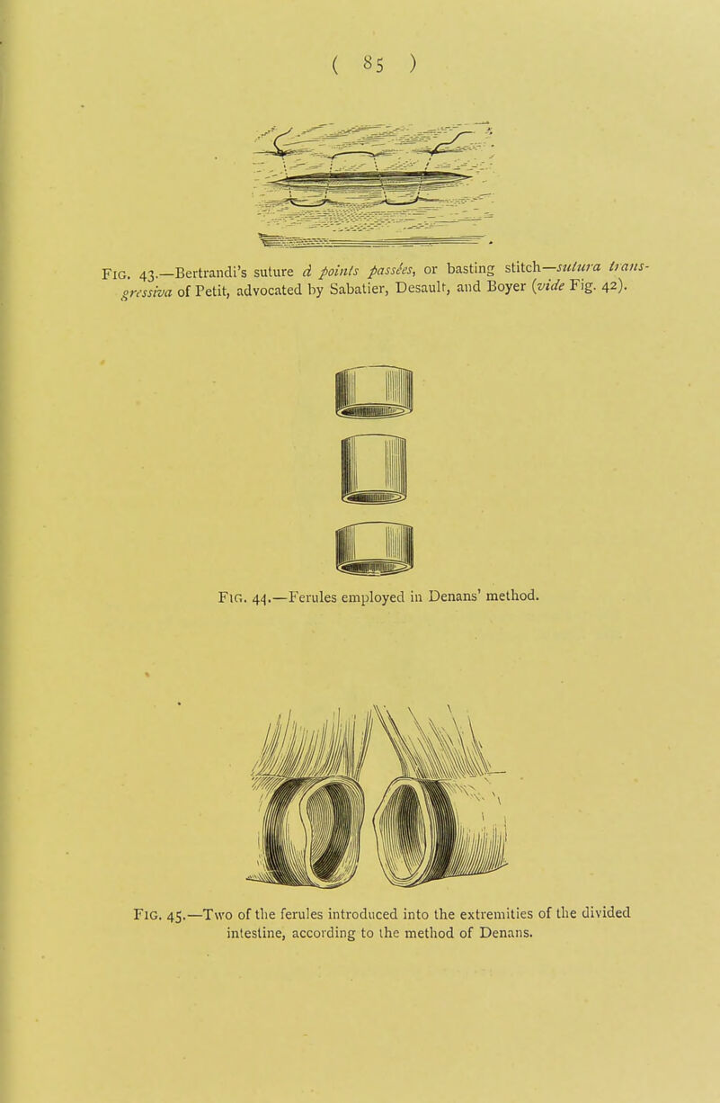 Fig. 43.—Bertrandi's suture d points passees, or basting stitch—«</«ra irans- gresshia of Petit, advocated by Sabatier, Desault, and Boyer {vide Fig. 42). Fig. 44.—Ferules employed in Denans' method. Fig. 45.—Two of the ferules introduced into the extremities of the divided intestine, according to the method of Denans.