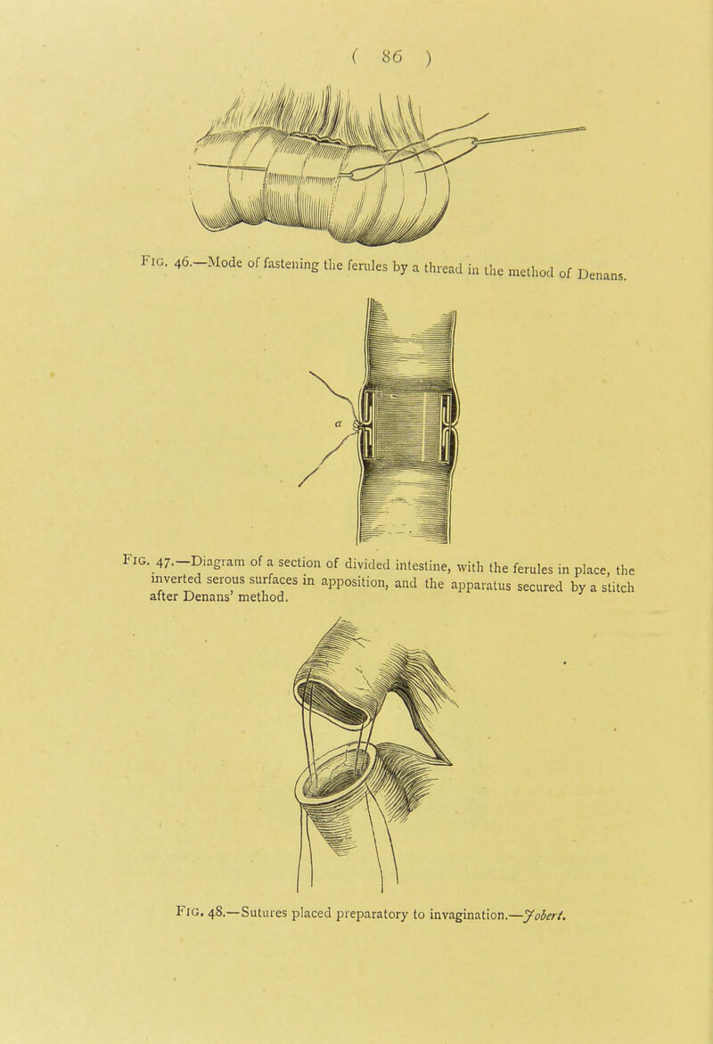 Fig. 46.-Mode of fastening the ferules by a thread ia the method of Denans, Fig. 47.-Diagiam of a section of divided intestine, with the ferules in place, the inverted serous surfaces in apposition, and the apparatus secured by a stitch after Denans method. Fig. 48.—Sutures placed preparatory to invagination.—Joberf.