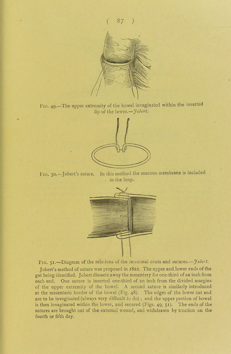 ( «7 ) Fig. 49.—The upper extremity of the bowel invaginated withui the inverted lip of the lower.—Jobcrt. Fig. 51.—Diagram of the relalions of the iniesiinal coats and sutures.—Jobei t. Jobert's method of suture was proposed in 1822. The upper and lower ends of the gut being identified. Jobert dissects away the mesentery for one-third of an inch from each end. One suture is inserted one-third of an inch from the divided margins of the upper extremity of the bowel. A second suture is similarly introduced at the mesenteric border of the bowel (Fig. 48). The edges of the lower cut end are to be invaginated (always very difficult t'j do); and the upper portion of bowel is then invaginated within the lower, and secured (Figs. 49, 51). The ends of the sutures are brought out of the external wound, and withdrawn by traction on the fourth or fifth day.