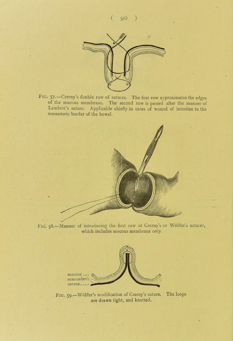 Fig. 57.—Czemy's double row of suluies. The first row approximates the edges of the mucous membrane. The second row is passed after the manner of Lembert's suture. Applicable chiefly in cases of wound of mtestine to the mesenteric border of the bowel. Fid. 58.—Manner of introducing the first row of Czerny's or Wolfler's sutuie.=, which includes mucous membrane only. mucosa .... muscularis cerosa Fig. 59.—Wolfler's modification of Czerny's suture. The loops are drawn tight, and knotted.