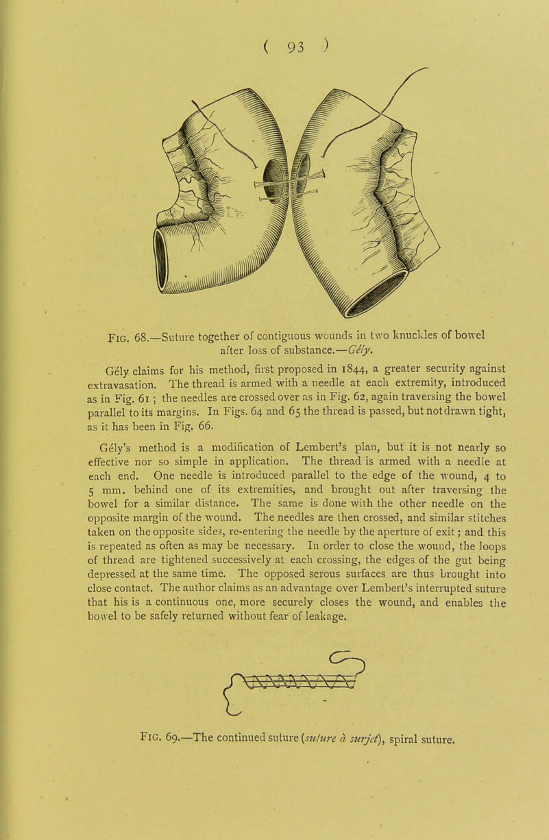 Fig. 68.—Suture together of contiguous wounds in two knuckles of bowel after loss of substance.—Gely, Gely claims for his method, first proposed in 1844, a greater security against extravasation. The thread is armed with a needle at each extremity, introduced as in Fig. 61 ; the needles are crossed over as in Fig. 62, again traversing the bowel parallel to its margins. In Figs. 64 and 65 the thread is passed, but not drawn tight, as it has been in Fig. 66. Gely's method is a modification of Lembert's plan, but it is not nearly so effective nor so simple in application. The thread is armed with a needle at each end. One needle is introduced parallel to the edge of the wound, 4 to 5 mm. behind one of its extremities, and brought out after traversing the bowel for a similar distance. The same is done with the other needle on the opposite margin of the wound. The needles are then crossed, and similar stitches taken on the opposite sides, re-entering the needle by the aperture of exit; and this is repeated as often as may be necessary. In order to close the wound, the loops of thread are tightened successively at each crossing, the edges of the gut being depressed at the same time. The opposed serous surfaces are thus brought into close contact. The author claims as an advantage over Lembert's interrupted suture that his is a continuous one, more securely closes the wound, and enables the bowel to be safely returned without fear of leakage. Fig. 69.—The continued suture [suture h surjet), spiral suture.