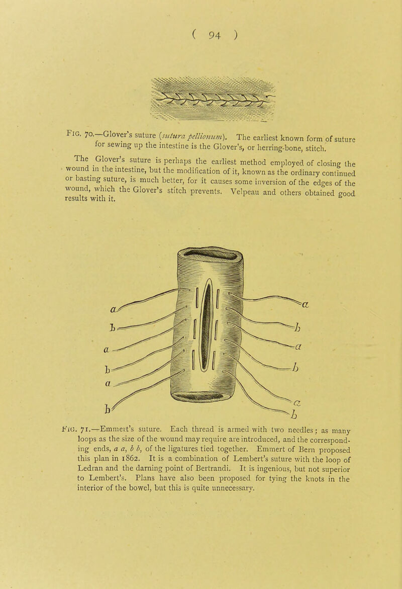 Fig. 7o.-Glover's suture {mttira pelliomun). The earliest known form of suture for sewing up the intestine is the Glover's, or herring-bone, stitch' The Glover's suture is perhaps the earliest method employed of closing the wound in the intestine, but the modification of it, known as the ordinaiy continued or basting suture, is much better, for it causes some inversion of the edges of the wound, which the Glover's stitch prevents. Velpeau and others obtained good results with it. - FiO. 71.—Emmert's suture. Each thread is armed with two needles; as many loops as the size of the wound may require are introduced, and the correspond- ing ends, a b b, of the ligatures tied together. Emmert of Bern proposed this plan in 1862. It is a combination of Lembert's suture with the loop of Ledran and the darning point of Bertrandi. It is ingenious, but not superior to Lembert's. Plans have also been proposed for tying the knots in the interior of the bowel, but this is quite unnecessary.