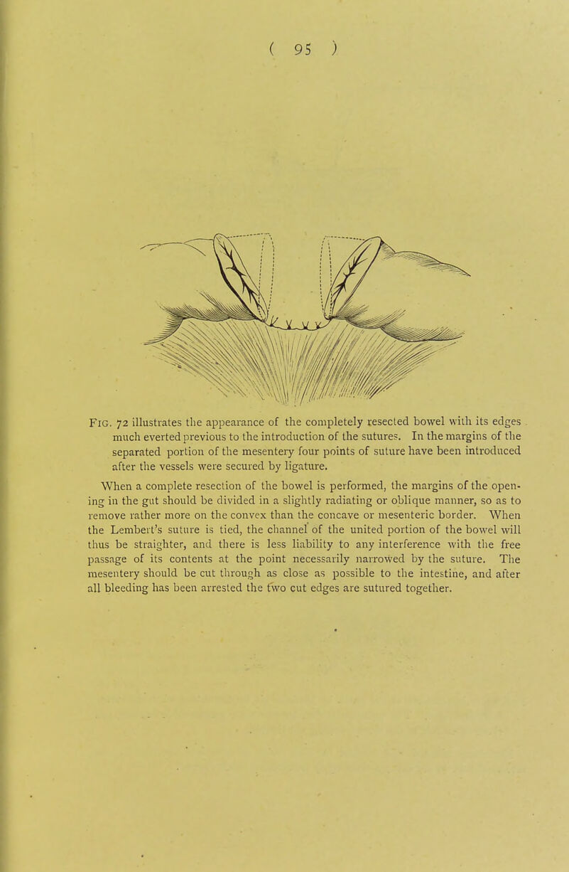 Fig. 72 illustrates the appearance of the completely resected bowel with its edges much everted previous to the introduction of the suture?. In the margins of the separated portion of the mesentery four points of suture have been introduced after tlie vessels were secured by ligature. When a complete resection of the bowel is performed, the margins of the open- ing in the gut should be divided in a slightly radiating or oblique manner, so as to remove rather more on the convex than the concave or mesenteric border. When the Lambert's suture is tied, the channel of the united portion of the bowel will thus be straighten, and there is less liability to any interference with the free passage of its contents at the point necessarily narrowed by the suture. The mesentery should be cut through as close as possible to the intestine, and after all bleeding has been arrested the two cut edges are sutured together.