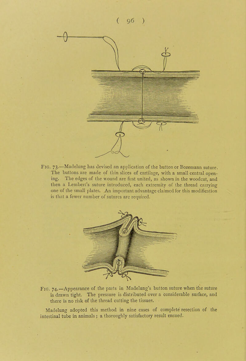 Fig. 73.—Madelung has devised an application of the button or Bozemann suture. The buttons are made of tliin slices of cartilage, with a small central open- ing. The edges of the wound are first united, as shown in the woodcut, and then a Lembert's suture introduced, each extremity of the thread carrying one of the small plates. An important advantage claimed for this modification is that a fcM'er number of sutures are required. Fig. 74.—Appearance of the parts in Madelung's button suture when the suture is drawn tight. The pressure is distributed over a considerable surface, and there is no risk of the thread cutting the tissues. Madelung adopted this method in nine cases of complete resection of the intestinal tube in animals; a thoroughly satisfactory result ensued.