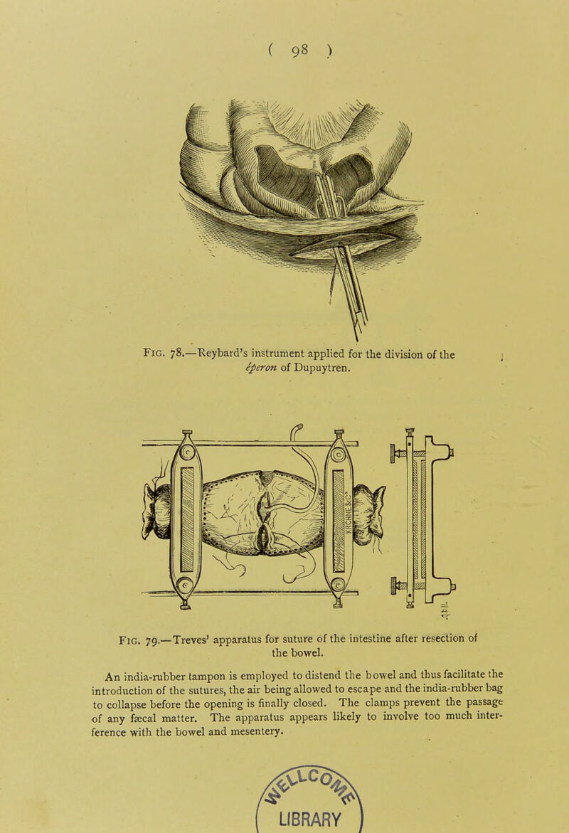 Fig. 78.—Reybard's instrument applied for the division of the eperon of Dupuytren. Fig. 79.—Treves' apparatus for suture of the intestine after resection of the bowel. An india-rubber tampon is employed to distend the bowel and thus facilitate the introduction of the sutures, the air being allowed to escape and the india-rubber bag to collapse before the opening is finally closed. The clamps prevent the passage of any fsecal matter. The apparatus appears likely to involve too much inter- ference with the bowel and mesentery.