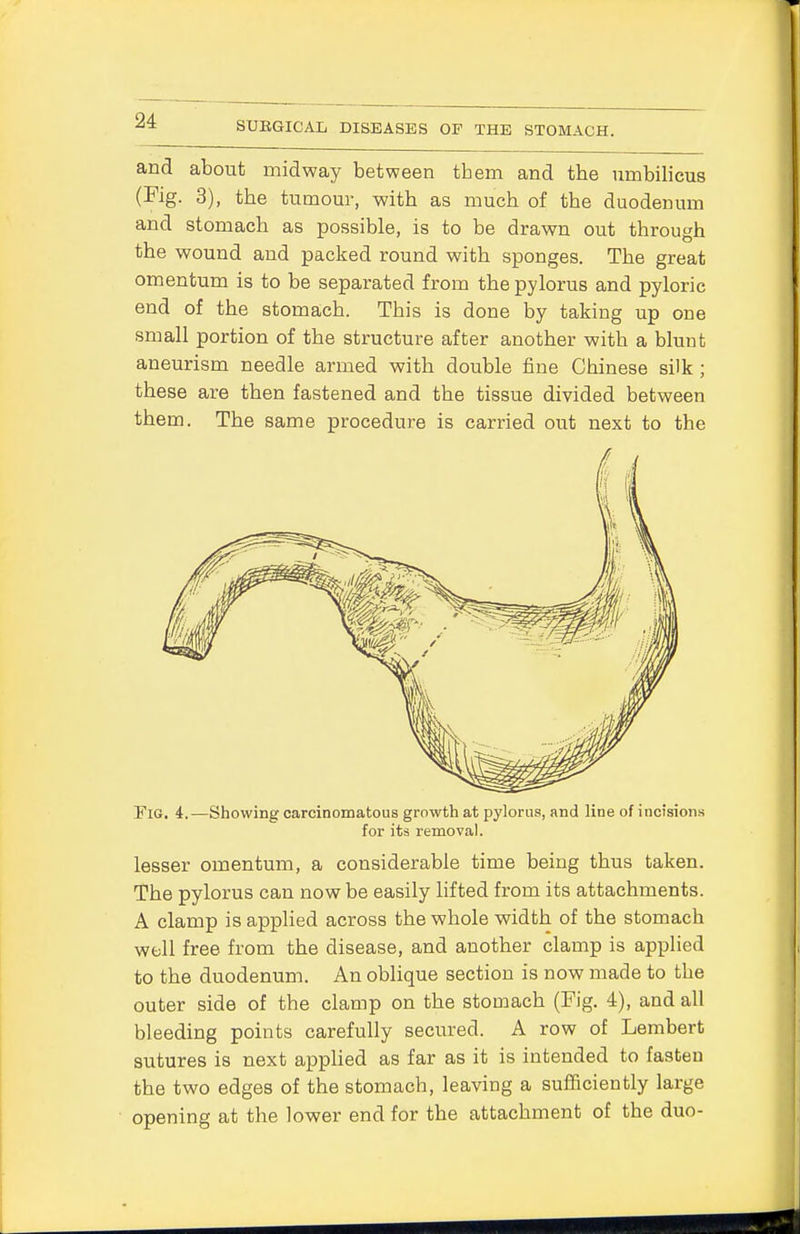 and about midway between tbem and the umbilicus (Fig. 3), the tumour, with as much of the duodenum and stomach as possible, is to be drawn out through the wound and packed round with sponges. The great omentum is to be separated from the pylorus and pyloric end of the stomach. This is done by taking up one small portion of the structure after another with a blunt aneurism needle armed with double fine Chinese silk ; these are then fastened and the tissue divided between them. The same procedure is carried out next to the Fig. 4.—Showing carcinomatous growth at pylorus, and line of incisions for its removal. lesser omentum, a considerable time being thus taken. The pylorus can now be easily lifted from its attachments. A clamp is applied across the whole width of the stomach well free from the disease, and another clamp is applied to the duodenum. An oblique section is now made to the outer side of the clamp on the stomach (Fig. 4), and all bleeding points carefully secured. A row of Lembert sutures is next applied as far as it is intended to fasten the two edges of the stomach, leaving a sufficiently large opening at the lower end for the attachment of the duo-