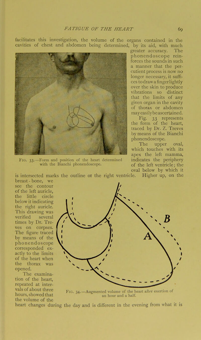 Fig. 33. -Form and position of the heart determined with the Bianchi phonendoscope. facilitates this investigation, the volume of the organs contained in the cavities of chest and abdomen being determined, by its aid, with much greater accuracy. The phonendoscope rein- forces the sounds in such a manner that the per- cutient process is now no longer necessary, it sufifi- ces todrawafingerlightly over the skin to produce vibrations so distinct that the limits of any i!;iven organ in the cavity if thorax or abdomen may easily be ascertained. I^ig- 33 represents the form of the heart, traced by Dr. Z. Treves by means of the Bianchi phonendoscope. The upper oval, which touches with its apex the left mamma, indicates the periphery of the left ventricle ; the oval below by which it is intersected marks the outline ot the right ventricle. Higher up, on the breast - bone, we see the contour of the left auricle, the little circle below it indicating the right auricle. This drawing was verified several times by Dr. Tre- ves on corpses. The figure traced by means of the phonendos cope corresponded ex- actly to the limits of the heart when the thorax was opened. The examina- tion of the heart, repeated at inter- vals of about three hours, showed that the volume of the heart changes during the day and is different in the evening from what it is Fig. 34. -Augmented vohimc of the heart after exertion of an hour and a half.