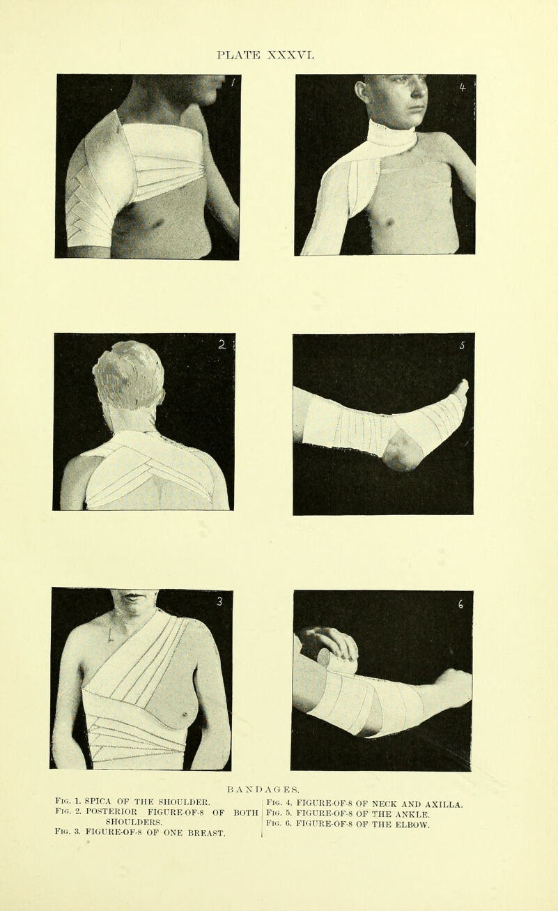 Fig. 1. SPICA OF THE SHOULDER. Fig. 2. POSTERIOR FIGURE-OF-8 OF BOTH SHOULDERS. Fig. 3. FIGURE-OF-8 OF ONE BREAST. BANDAGES. Fig. 4. FIGURE-OF-8 OF NECK AND AXILLA. Fig. 5. FIGURE-OF-8 OF ™HE ANKLE. Fig. 6. FIGURE-OF-8 OF THE ELBOW.