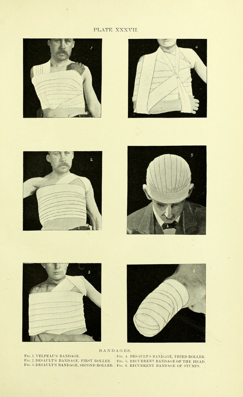 BANDAGES. Fig. 1. VELPEAU'S BANDAGE. - Fig. 4. DEFAULT'S BANDAGE, THIRD ROLLER. Fig. 2. DESAULT'S BANDAGE, FIRST ROLLER. | Fig. 5. RECURRENT BANDAGE OF THE HEAD. Fig. 3. DESAULT'S BANDAGE, SECOND ROLLER. | Fig. 6. RECURRENT BANDAGE OF STUMPS.
