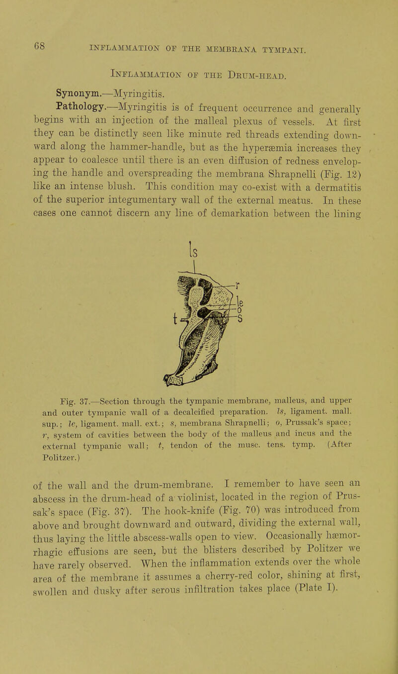 INPLAMMATION OP THE MEMBEANA TYMPANI. Inflammation op the Drum-head. Sjoionym.—Myringitis. Pathology.—Myringitis is of frequent occurrence and generally begins with an injection of the malleal plexus of vessels. At first they can be distinctly seen like minute red threads extending down- ward along the hammer-handle, but as the hypersemia increases they appear to coalesce until there is an even diffusion of redness envelop- ing the handle and overspreading the membrana Shrapnelli (Fig. 12) like an intense blush. This condition may co-exist with a dermatitis of the superior integumentary wall of the external meatus. In these cases one cannot discern any line of demarkation between the lining Fig. 37.—Section through the tympanic membrane, malleus, and upper and outer tympanic wall of a decalcified preparation. Is, ligament, mall, sup.; Ic, ligament, mall, ext.; S, membrana Shrapnelli; o, Prussak's space; r, system of cavities between the body of the malleus and incus and the external tympanic wall; t, tendon of the muse. tens. tymp. (After Politzer.) of the wall and the drum-membrane. I remember to have seen an abscess in the drum-head of a violinist, located in the region of Prus- sak's space (Fig. 37). The hook-knife (Fig. 70) was introduced from above and brought downward and outward, dividing the external wall, thus laying the little abscess-walls open to view. Occasionally hemor- rhagic effusions are seen, but the blisters described by Politzer we have rarely observed. When the inflammation extends over the whole area of the membrane it assumes a cherry-red color, shining at first, swollen and dusky after serous infiltration takes place (Plate I). Is