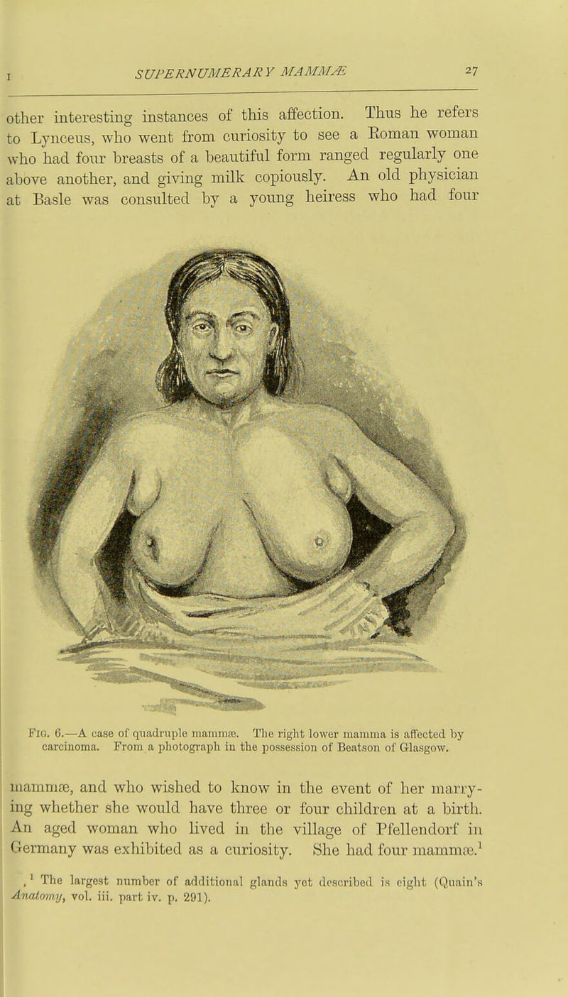Other interesting instances of this affection. Thus he refers to Lynceus, who went from curiosity to see a Eoman woman who had four breasts of a beautiful form ranged regularly one above another, and giving milk copiously. An old physician at Basle was consulted by a young heiress who had four Fio. 6.—A case of quadruple maniniai. Tlie right lower mamma is aflfected by carcinoma. From a pliotograpli in the possession of Beatson of Glasgow. mammae, and who wished to know in the event of her marry- < ing whether she would have three or four children at a birth. An aged woman who lived in the village of Pfellendorf in Germany was exhibited as a curiosity. She had four mammaj.^ ,' The largest number of additional glands yet doscribed is eight (Quain'.s Anatomy, vol. iii. part iv. p. 291).