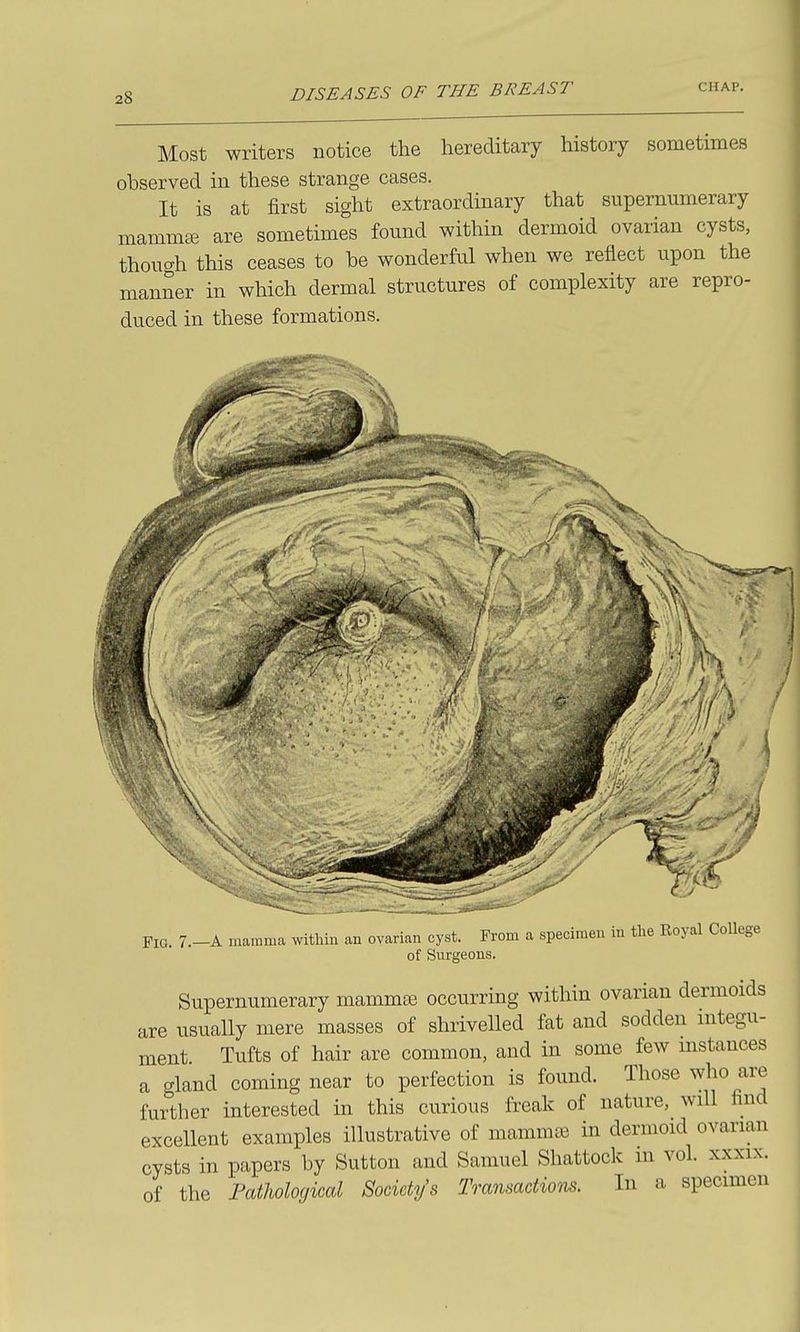 Most writers notice the hereditary history sometimes observed in these strange cases. It is at first sight extraordinary that supernumerary mammse are sometimes found within dermoid ovarian cysts, though this ceases to be wonderful when we reflect upon the manner in which dermal structures of complexity are repro- duced in these formations. Fig. 7.-A mamma within an ovarian cyst. From a specimen in the Royal CoUege of Surgeons. Supernumerary mammee occurring within ovarian dermoids are usually mere masses of shrivelled fat and sodden integu- ment Tufts of hair are common, and in some few mstances a gland coming near to perfection is found. Those who are further interested in this curious freak of nature, will find excellent examples illustrative of mammas in dermoid ovarian cysts in papers by Sutton and Samuel Shattock m vol. xxxix. of the Fatlwloqical Society's Tmnmotiom. In a specimen