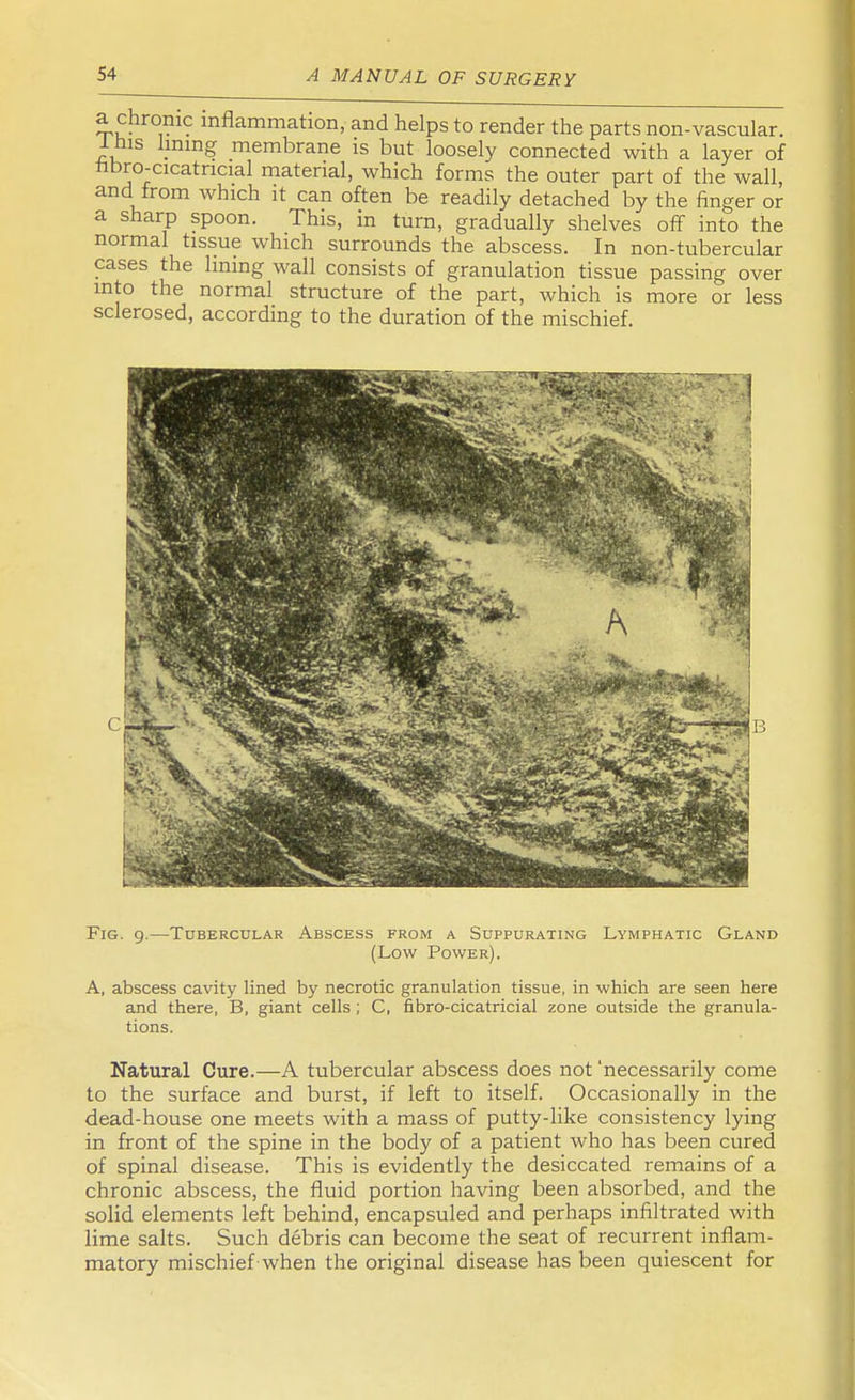 a chronic inflammation, and helps to render the parts non-vascular. 1 bis hmng membrane is but loosely connected with a layer of nbro-cicatncial material, which forms the outer part of the wall, and from which it can often be readily detached by the finger or a sharp spoon. This, in turn, gradually shelves off into the normal tissue which surrounds the abscess. In non-tubercular cases the lining wall consists of granulation tissue passing over into the normal structure of the part, which is more or less sclerosed, according to the duration of the mischief. Fig. 9.—Tubercular Abscess from a Suppurating Lymphatic Gland (Low Power). A, abscess cavity lined by necrotic granulation tissue, in which are seen here and there, B, giant cells ; C, fibro-cicatricial zone outside the granula- tions. Natural Cure.—A tubercular abscess does not 'necessarily come to the surface and burst, if left to itself. Occasionally in the dead-house one meets with a mass of putty-like consistency lying in front of the spine in the body of a patient who has been cured of spinal disease. This is evidently the desiccated remains of a chronic abscess, the fluid portion having been absorbed, and the solid elements left behind, encapsuled and perhaps infiltrated with lime salts. Such debris can become the seat of recurrent inflam- matory mischief when the original disease has been quiescent for