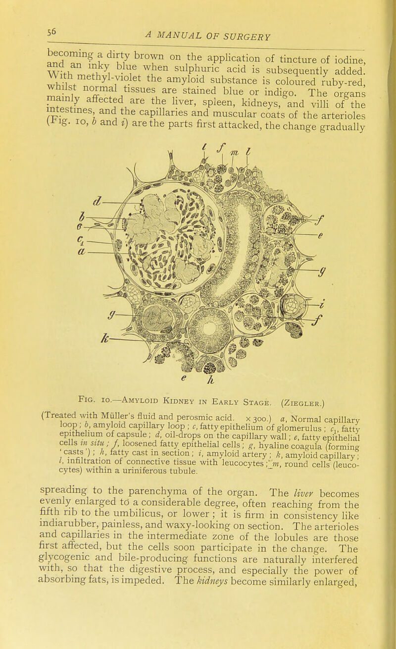 and ?n ? I KiY br° un °n the aPPlicati°n of tincture of iodine, Whh ble/!jen sul,Phuric acid ^ subsequently added. With methyl-violet the amyloid substance is coloured ruby-red, whilst normal tissues are stained blue or indigo. The organs SSstLaffeCHelare thr? Hv6r' Splgen' kidneys,gand villi ofthe intestines and_ the capillaries and muscular coats of the arterioles l-rig. 10, b and %) are the parts first attacked, the change gradually Fig. io.—Amyloid Kidney in Early Stage. (Ziegler.) (Treated with MuUer's fluid and perosmic acid, x 300.) a, Normal capillary loop ; b, amyloid capillary loop ; c, fatty epithelium of glomerulus ; c, fatty epithelium of capsule; d, oil-drops on the capillary wall; e, fatty epithelial cells mi nto; f, loosened fatty epithelial cells; g, hyaline coagula (forming 'casts ); h, fatty cast in section; i, amyloid artery ; k, amyloid capillary I, infiltration of connective tissue with leucocytes ;m, round cells (leuco- cytes) within a uriniferous tubule. spreading to the parenchyma of the organ. The liver becomes evenly enlarged td a considerable degree, often reaching from the fifth rib to the umbilicus, or lower ; it is firm in consistency like mdiarubber, painless, and waxy-looking on section. The arterioles and capillaries in the intermediate zone of the lobules are those first affected, but the cells soon participate in the change. The glycogenic and bile-producing functions are naturally interfered with, so that the digestive process, and especially the power of absorbing fats, is impeded. The kidneys become similarly enlarged,