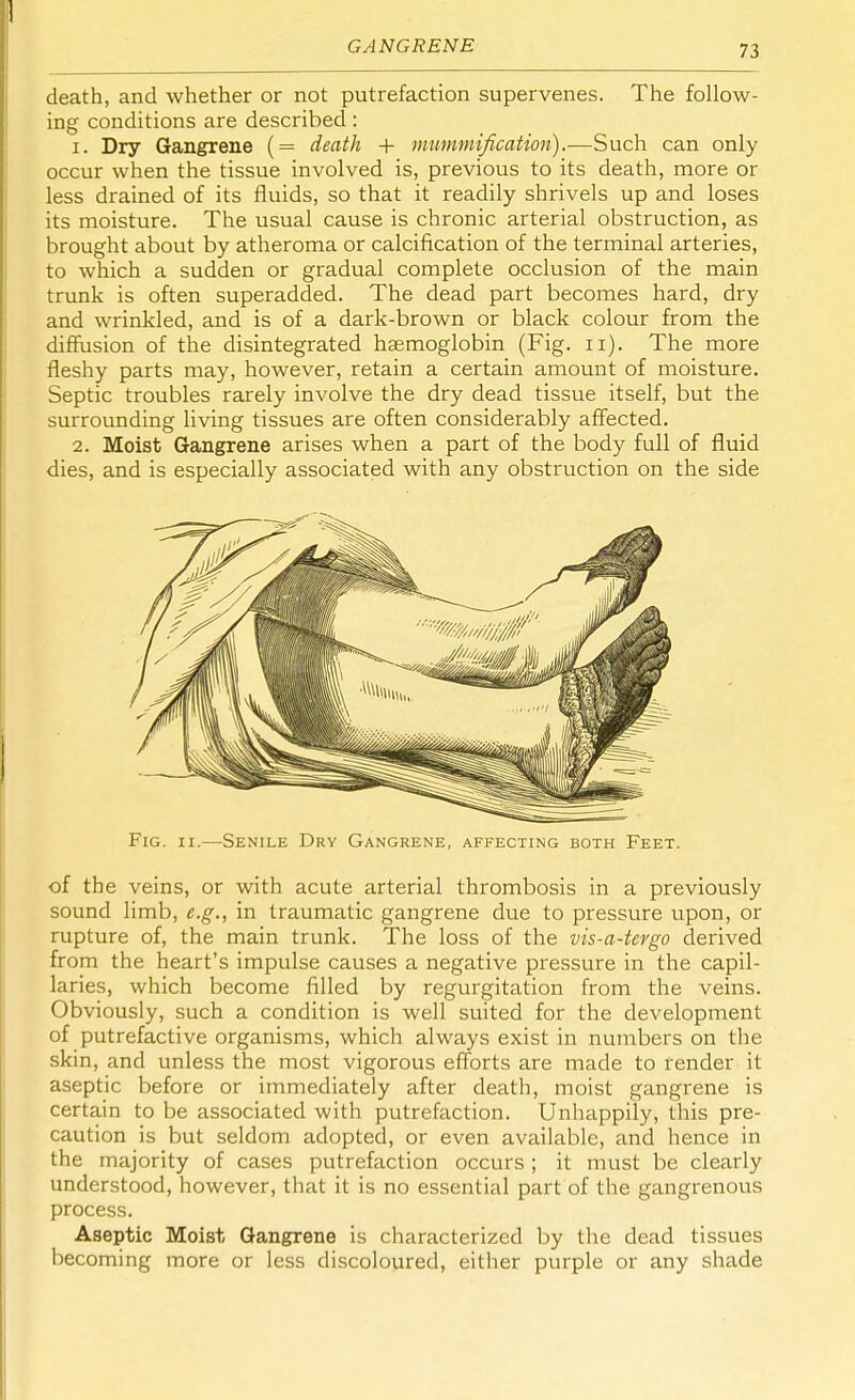 7.5 death, and whether or not putrefaction supervenes. The follow- ing conditions are described: 1. Dry Gangrene (= death + mummification).-—-Such can only occur when the tissue involved is, previous to its death, more or less drained of its fluids, so that it readily shrivels up and loses its moisture. The usual cause is chronic arterial obstruction, as brought about by atheroma or calcification of the terminal arteries, to which a sudden or gradual complete occlusion of the main trunk is often superadded. The dead part becomes hard, dry and wrinkled, and is of a dark-brown or black colour from the diffusion of the disintegrated haemoglobin (Fig. u). The more fleshy parts may, however, retain a certain amount of moisture. Septic troubles rarely involve the dry dead tissue itself, but the surrounding living tissues are often considerably affected. 2. Moist Gangrene arises when a part of the body full of fluid dies, and is especially associated with any obstruction on the side Fig. ii.—Senile Dry Gangrene, affecting both Feet. of the veins, or with acute arterial thrombosis in a previously sound limb, e.g., in traumatic gangrene due to pressure upon, or rupture of, the main trunk. The loss of the vis-a-tcrgo derived from the heart's impulse causes a negative pressure in the capil- laries, which become filled by regurgitation from the veins. Obviously, such a condition is well suited for the development of putrefactive organisms, which always exist in numbers on the skin, and unless the most vigorous efforts are made to render it aseptic before or immediately after death, moist gangrene is certain to be associated with putrefaction. Unhappily, this pre- caution is but seldom adopted, or even available, and hence in the majority of cases putrefaction occurs ; it must be clearly understood, however, that it is no essential part of the gangrenous process. Aseptic Moist Gangrene is characterized by the dead tissues becoming more or less discoloured, either purple or any shade