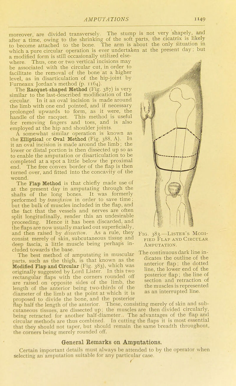 moreover, are divided transversely. The stump is not very shapely, and after a time, owing to the shrinking of the soft parts, the cicatrix is likely to become attached to the bone. The arm is about the only situation in which a pure circular operation is ever undertaken at the present day; but a modified form is still occasionally utilized else- where. Thus, one or two vertical incisions may be associated with the circular cut, in order to facilitate the removal of the bone at a higher level, as in disarticulation of the hip-joint by Furneaux Jordan's method (p. 1164). The Racquet-shaped Method (Fig. 387) is very similar to the last-described modification of the circular. In it an oval incision is made around the limb with one end pointed, and if necessary prolonged upwards to form, as it were, the handle of the racquet. This method is useful for removing fingers and toes, and is also employed at the hip and shoulder joints. A somewhat similar operation is known as the Elliptical or Oval Method (Fig. 388, A). In it an oval incision is made around the limb; the lower or distal portion is then dissected up so as to enable the amputation or disarticulation to be completed at a spot a little below the proximal end. The free convex border of the flap is then turned over, and fitted into the concavity of the wound. The Flap Method is that chiefly made use of at the present day in amputating through the shafts of the long bones. It was formerly performed by transfixion in order to save time; but the bulk of muscles included in the flap, and the fact that the vessels and nerves are often split longitudinally, render this an undesirable proceeding. Hence it has been discarded, and the flaps are now usually marked out superficially, and then raised by dissection. As a rule, they consist merely of skin, subcutaneous tissue and deep fascia, a little muscle being perhaps in- cluded towards the base. The best method of amputating in muscular parts, such as the thigh, is that known as the Modified Flap and Circular (Fig. 383), which was originally suggested by Lord Lister. In this two rectangular flaps with the corners rounded off are raised on opposite sides of the limb, the length of the anterior being two-thirds of the diameter of the limb at the point at which it is proposed to divide the bone, and the posterior Hap half the length of the anterior. These, consisting merely of skin and sub- cutaneous tissues, are dissected up; the muscles are then divided circularly, being retracted for another half-diameter.. The advantages of the flap and circular methods are thus combined. In cutting the flaps it is most essential that they should not taper, but should remain the same breadth throughout, the corners being merely rounded off. General Remarks on Amputations. Certain important details must always be attended to by the operator when Selecting an amputation suitable for any particular case. Fig. 383.—Lister's Modi- fied Flap and Circular Amputation. The continuous dark line in- dicates the outline of the anterior flap ; the dotted line, the lower end of the posterior flap; the line of section and retraction of the muscles is represented as an interrupted line.