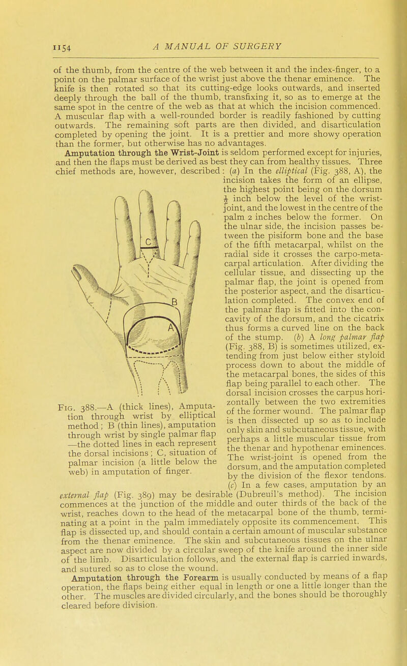 of the thumb, from the centre of the web between it and the index-finger, to a point on the palmar surface of the wrist just above the thenar eminence. The knife is then rotated so that its cutting-edge looks outwards, and inserted deeply through the ball of the thumb, transfixing it, so as to emerge at the same spot in the centre of the web as that at which the incision commenced. A muscular flap with a well-rounded border is readily fashioned by cutting outwards. The remaining soft parts are then divided, and disarticulation completed by opening the joint. It is a prettier and more showy operation than the former, but otherwise has no advantages. Amputation through the Wrist-Joint is seldom performed except for injuries, and then the flaps must be derived as best they can from healthy tissues. Three chief methods are, however, described: (a) In the elliptical (Fig. 388, A), the incision takes the form of an ellipse, the highest point being on the dorsum J inch below the level of the wrist- joint, and the lowest in the centre of the palm 2 inches below the former. On the ulnar side, the incision passes be- tween the pisiform bone and the base of the fifth metacarpal, whilst on the radial side it crosses the carpo-meta- carpal articulation. After dividing the cellular tissue, and dissecting up the palmar flap, the joint is opened from the posterior aspect, and the disarticu- lation completed. The convex end of the palmar flap is fitted into the con- cavity of the dorsum, and the cicatrix thus forms a curved line on the back of the stump, (b) A long palmar flap (Fig. 388, B) is sometimes utilized, ex- tending from just below either styloid process down to about the middle of the metacarpal bones, the sides of this flap being parallel to each other. The dorsal incision crosses the carpus hori- zontally between the two extremities of the former wound. The palmar flap is then dissected up so as to include only skin and subcutaneous tissue, with perhaps a little muscular tissue from the thenar and hypothenar eminences. The wrist-joint is opened from the dorsum, and the amputation completed by the division of the flexor tendons. (c) In a few cases, amputation by an external flap (Fig. 389) may be desirable (Dubreuil's method). The incision commences at the junction of the middle and outer thirds of the back of the wrist, reaches down to the head of the metacarpal bone of the thumb, termi- nating at a point in the palm immediately opposite its commencement. This flap is dissected up, and should contain a certain amount of muscular substance from the thenar eminence. The skin and subcutaneous tissues on the ulnar aspect are now divided by a circular sweep of the knife around the inner side of the limb. Disarticulation follows, and the external flap is carried inwards, and sutured so as to close the wound. Amputation through the Forearm is usually conducted by means of a flap operation, the flaps being either equal in length or one a little longer than the other. The muscles are divided circularly, and the bones should be thoroughly cleared before division. Fig. 388.—A (thick lines), Amputa- tion through wrist by elliptical method ; B (thin lines), amputation through wrist by single palmar flap —the dotted lines in each represent the dorsal incisions ; C, situation of palmar incision (a little below the web) in amputation of finger.