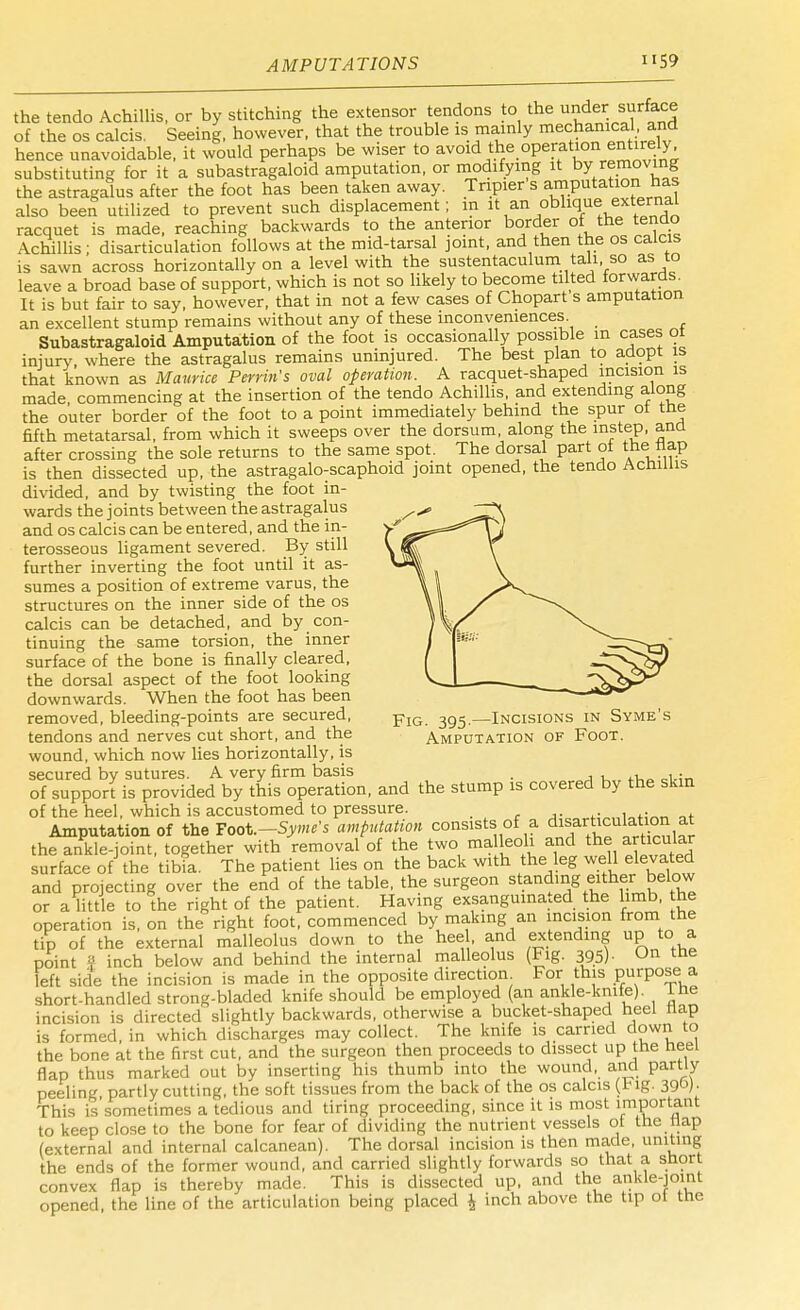 the tendo Achillis, or by stitching the extensor tendons to the under surface of the os calcis. Seeing, however, that the trouble is mainly mechanical and hence unavoidable, it would perhaps be wiser to avoid the opera ^entirely, substituting for it a subastragaloid amputation, or modifying it by removing the astragalus after the foot has been taken away. Tripier s amputation has also been utilized to prevent such displacement; in it iin oblique.external racquet is made, reaching backwards to the anterior border of the tendo Achillis; disarticulation follows at the mid-tarsal joint, and then the os calcis is sawn across horizontally on a level with the sustentaculum tali, so as to leave a broad base of support, which is not so likely to become tilted forwards. It is but fair to say, however, that in not a few cases of Chopart s amputation an excellent stump remains without any of these inconveniences Subastragaloid Amputation of the foot is occasionally possible in cases 01 injury, where the astragalus remains uninjured. The best plan to adopt is that known as Maurice Perrin's oval operation. A racquet-shaped incision is made, commencing at the insertion of the tendo Achillis, and extending along the outer border of the foot to a point immediately behind the spur ot tne fifth metatarsal, from which it sweeps over the dorsum, along the instep, and after crossing the sole returns to the same spot. The dorsal part ot thet flap is then dissected up, the astragalo-scaphoid joint opened, the tendo Achillis divided, and by twisting the foot in- wards the joints between the astragalus and os calcis can be entered, and the in- terosseous ligament severed. By still further inverting the foot until it as- sumes a position of extreme varus, the structures on the inner side of the os calcis can be detached, and by con- tinuing the same torsion, the inner surface of the bone is finally cleared, the dorsal aspect of the foot looking downwards. When the foot has been removed, bleeding-points are secured, pIG ^—Incisions in Syme's tendons and nerves cut short, and the Amputation of Foot. wound, which now lies horizontally, is secured by sutures. A very firm basis ,. of support is provided by this operation, and the stump is covered by the skin of the heel, which is accustomed to pressure. Amputation of the Toot.-Syme's amputation consists of a disarticulation at the ankle-joint, together with removal of the two malleoli and the articular surface of the tibia, The patient lies on the back with the leg well elevated and projecting over the end of the table, the surgeon standing either below or a little to the right of the patient. Having exsanguinated the limb, the operation is, on the right foot, commenced by making an incision from the tip of the external malleolus down to the hee , and extending up to a point S inch below and behind the internal malleolus (Fig. 39.5) • On the left side the incision is made in the opposite direction For this purpose a short-handled strong-bladed knife should be employed (an ankle-knife). Lhe incision is directed slightly backwards, otherwise a bucket-shaped heel flap is formed, in which discharges may collect. The knife is carried down to the bone at the first cut, and the surgeon then proceeds to dissect up the heel flap thus marked out by inserting his thumb into the wound, and partly peeling partly cutting, the soft tissues from the back of the os calcis {tig. 39°). This is sometimes a tedious and tiring proceeding, since it is most important to keep close to the bone for fear of dividing the nutrient vessels ot the Hap (external and internal calcanean). The dorsal incision is then made, uniting the ends of the former wound, and carried slightly forwards so that a, short convex flap is thereby made. This is dissected up, and the ankle-joint opened, the line of the articulation being placed £ inch above the tip ot the