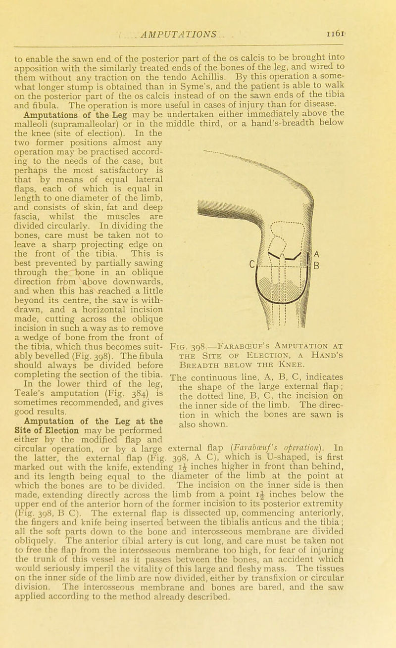 to enable the sawn end of the posterior part of the os calcis to be brought into apposition with the similarly treated ends of the bones of the leg, and wired to them without any traction on the tendo Achillis. By this operation a some- what longer stump is obtained than in Syme's, and the patient is able to walk on the posterior part of the os calcis instead of on the sawn ends of the tibia and fibula. The operation is more useful in cases of injury than for disease. Amputations of the Leg may be undertaken either immediately above the malleoli (supramalleolar) or in the middle third, or a hand's-breadth below the knee (site of election). In the two former positions almost any operation may be practised accord- — ,. ing to the needs of the case, but ^^ss^ perhaps the most satisfactory is that by means of equal lateral flaps, each of which is equal in length to one diameter of the limb, and consists of skin, fat and deep fascia, whilst the muscles are divided circularly. In dividing the bones, care must be taken not to leave a sharp projecting edge on the front of the tibia. This is best prevented by partially sawing through the bone in an oblique direction from above downwards, and when this has reached a little beyond its centre, the saw is with- drawn, and a horizontal incision made, cutting across the oblique incision in such a way as to remove a wedge of bone from the front of the tibia, which thus becomes suit- ably bevelled (Fig. 398). The fibula should always be divided before completing the section of the tibia. In the lower third of the leg, Teale's amputation (Fig. 384) is sometimes recommended, and gives good results. Amputation of the Leg at the Site of Election may be performed either by the modified flap and circular operation, or by a large the latter, the external flap (Fig Fig. 398.—Farabceuf's Amputation at the Site of Election, a Hand's Breadth below the Knee. The continuous line, A, B, C, indicates the shape of the large external flap; the dotted line, B, C, the incision on the inner side of the limb. The direc- tion in which the bones are sawn is also shown. external flap (Farabasuf's operation). In 398, A C), which is U-shaped, is first marked out with the knife, extending i£ inches higher in front than behind, and its length being equal to the diameter of the limb at the point at which the bones are to be divided. The incision on the inner side is then made, extending directly across the limb from a point i£ inches below the upper end of the anterior horn of the former incision to its posterior extremity 398, B C). The external flap is dissected up, commencing anteriorly, the fingers and knife being inserted between the tibialis anticus and the tibia; all the soft parts down to the bone and interosseous membrane are divided obliquely. The anterior tibial artery is cut long, and care must be taken not to free the flap from the interosseous membrane too high, for fear of injuring the trunk of this vessel as it passes between the bones, an accident which would seriously imperil the vitality of this large and fleshy mass. The tissues on the inner side of the limb are now divided, either by transfixion or circular division. The interosseous membrane and bones are bared, and the saw applied according to the method already described.