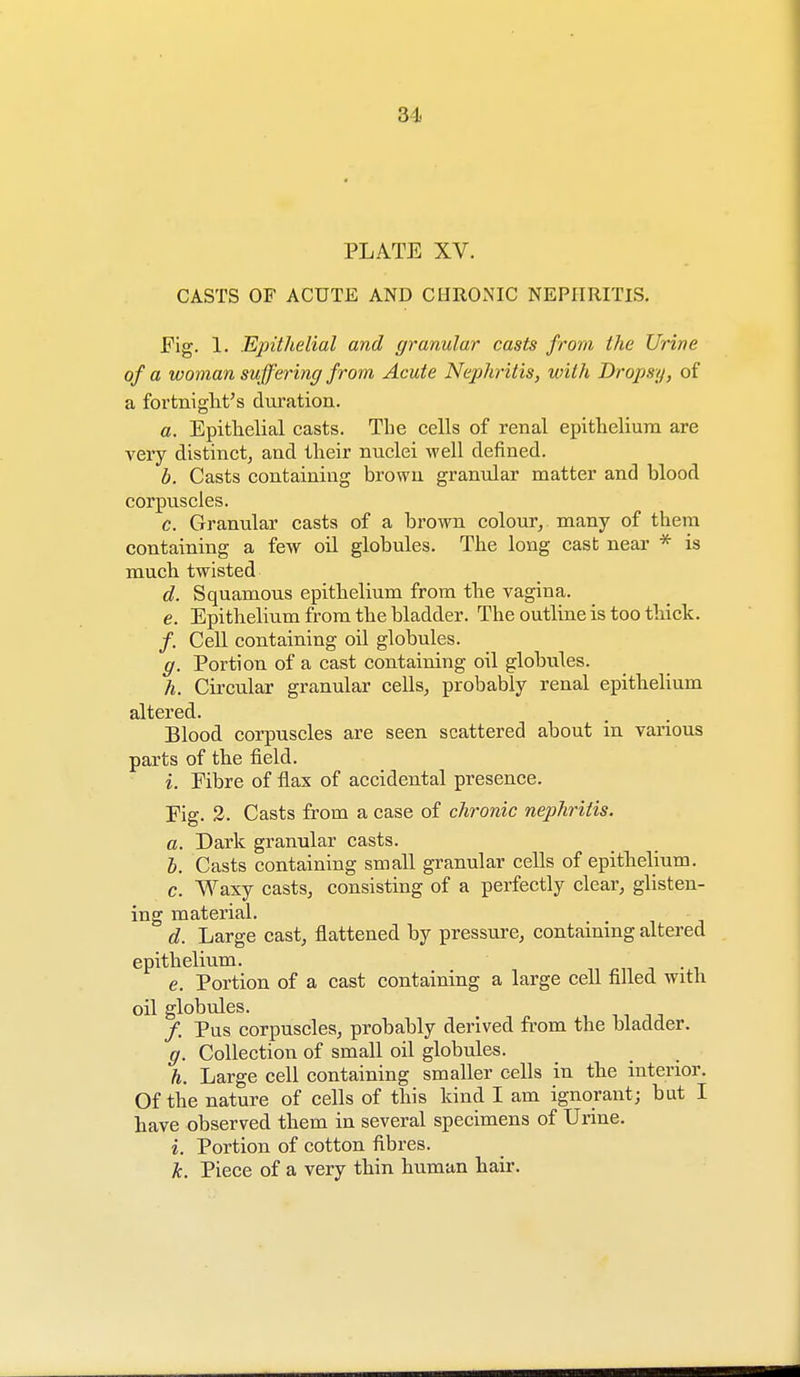 PLATE XV. CASTS OF ACUTE AND CHRONIC NEPHRITIS. Fig. 1. Epithelial and granular casts from the Urine of a woman suffering from Acute Nephritis, with Dropsy, of a fortnight's duration. a. Epithelial casts. The cells of renal epithelium are very distinct, and their nuclei well denned. b. Casts containing brown granular matter and blood corpuscles. c. Granular casts of a brown colour, many of them containing a few oil globules. The long cast near * is much twisted d. Squamous epithelium from the vagina. e. Epithelium from the bladder. The outline is too thick. /. Cell containing oil globules. g. Portion of a cast containing oil globules. h. Circular granular cells, probably renal epithelium altered. Blood corpuscles are seen scattered about in various parts of the field. i. Fibre of flax of accidental presence. Fig. 2. Casts from a case of chronic nephritis. a. Dark granular casts. b. Casts containing small granular cells of epithelium. c. Waxy casts, consisting of a perfectly clear, glisten- ing material. d. Large cast, flattened by pressure, containing altered epithelium. e. Portion of a cast containing a large cell filled with oil globules. /. Pus corpuscles, probably derived from the bladder. g. Collection of small oil globules. h. Large cell containing smaller cells in the interior. Of the nature of cells of this kind I am ignorant; but I have observed them in several specimens of Urine. i. Portion of cotton fibres. k. Piece of a very thin human hair.