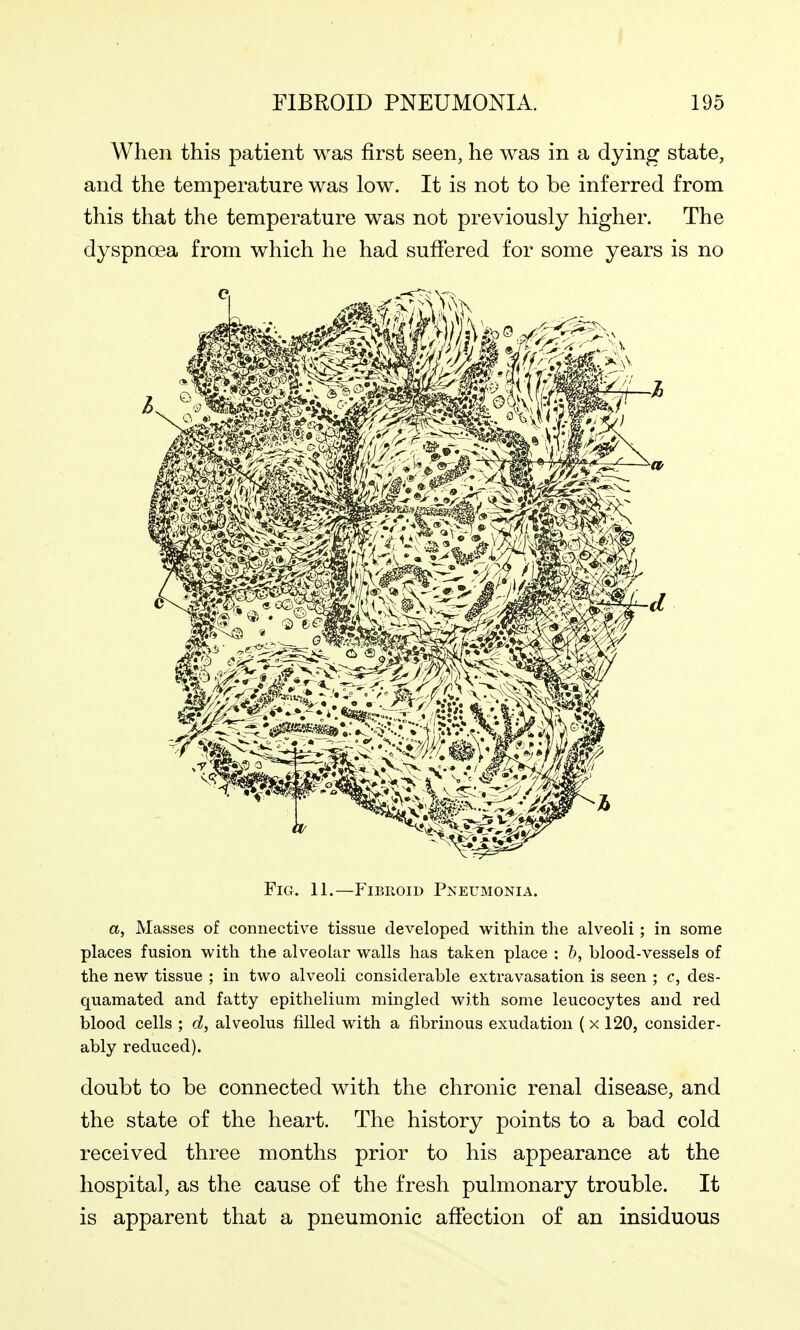 When this patient was first seen, he was in a dying state, and the temperature was low. It is not to be inferred from this that the temperature was not previously higher. The dyspnoea from which he had suffered for some years is no Fig. 11.—FiBuoiD Pneumonia. a, Masses of connective tissue developed within the alveoli ; in some places fusion with the alveolar walls has taken place : &, blood-vessels of the new tissue ; in two alveoli considerable extravasation is seen ; c, des- quamated and fatty epithelium mingled with some leucocytes and red blood cells ; d, alveolus filled with a fibrinous exudation (x 120, consider- ably reduced). doubt to be connected with the chronic renal disease, and the state of the heart. The history points to a bad cold received three months prior to his appearance at the hospital, as the cause of the fresh pulmonary trouble. It is apparent that a pneumonic affection of an insiduous