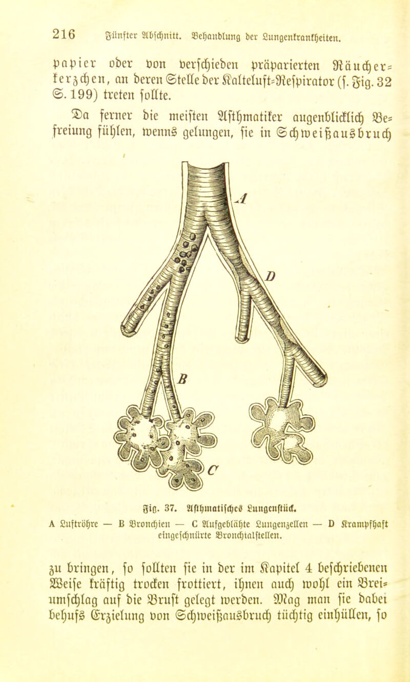 pnpicr ober öon berfd^ieben präparierten 9?äud^er= ferädjen, an beren(Steaebcr^aIteIuft=9iefpirator(f.gig.32 ©.199) treten fottte. ®o ferner bte nieiften Slff^mattfcr augenblicflid) 93e= freiung füfjlen, Jrenn§ gelungen, fie in ©d)n)ei^au§brutf} giO. 37. MfHjiiiotifi^cä Suiißcnfliiif. A Cuftrö^irc — B SöroiicOicii — C 3lufgc6[äf)te fiimflenäclleu — D Srompf^aft eiiigcfd;nürte SBvonrfjialftcHcn. gu bringen, fo foütcn fie in ber im ^opitel 4 befd^riebenen Söeife fröftig trocEen frottiert, ifjucn and) \vol)l ein 5Sret* xmifd)Iag auf bie 93ruft gelegt incrben. Wqq man fie babei beljufS e-räielung üon (Sd)ineij30u§brud) tüdjtig eintjüHen, fo